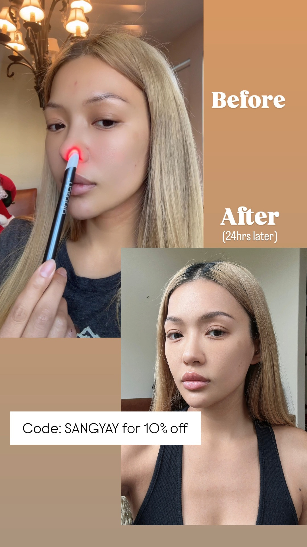 Fastest way to get rid of acne!
 
#acne #acnewand #skincare #beautydevice #skincaredevice

#LTKBeauty #LTKSaleAlert #LTKGiftGuide