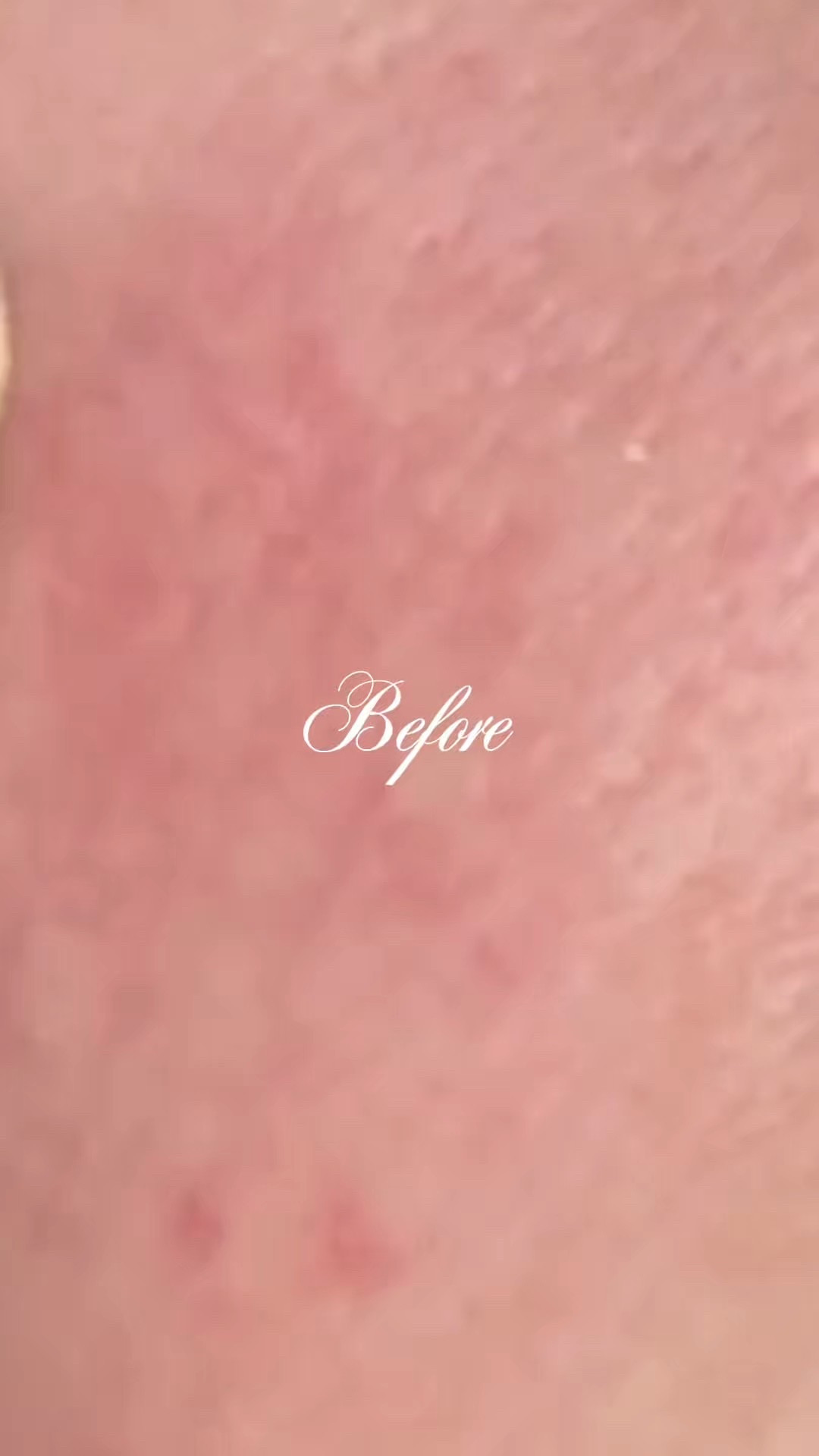 This is my skin before and after using my everyday skincare routine 🤍

I deal with rosacea, so keeping my skin calm and balanced is always my main focus. Lately my skin has been feeling more hydrated, more even, and just healthier overall.

I wanted to share what I’ve been using in case it helps someone else with sensitive or redness-prone skin too.















































#LTKbeauty
#LTKskincare
#LTKfinds
#LTKunder50
#SkincareRoutine
#SensitiveSkin
#RosaceaCare
#CalmSkin