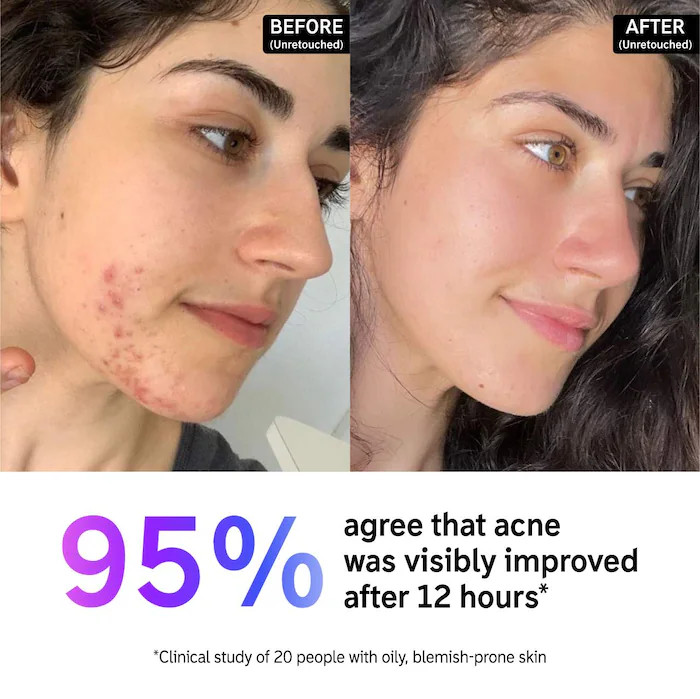 Succinic Acid Acne Treatment | Sephora (US)