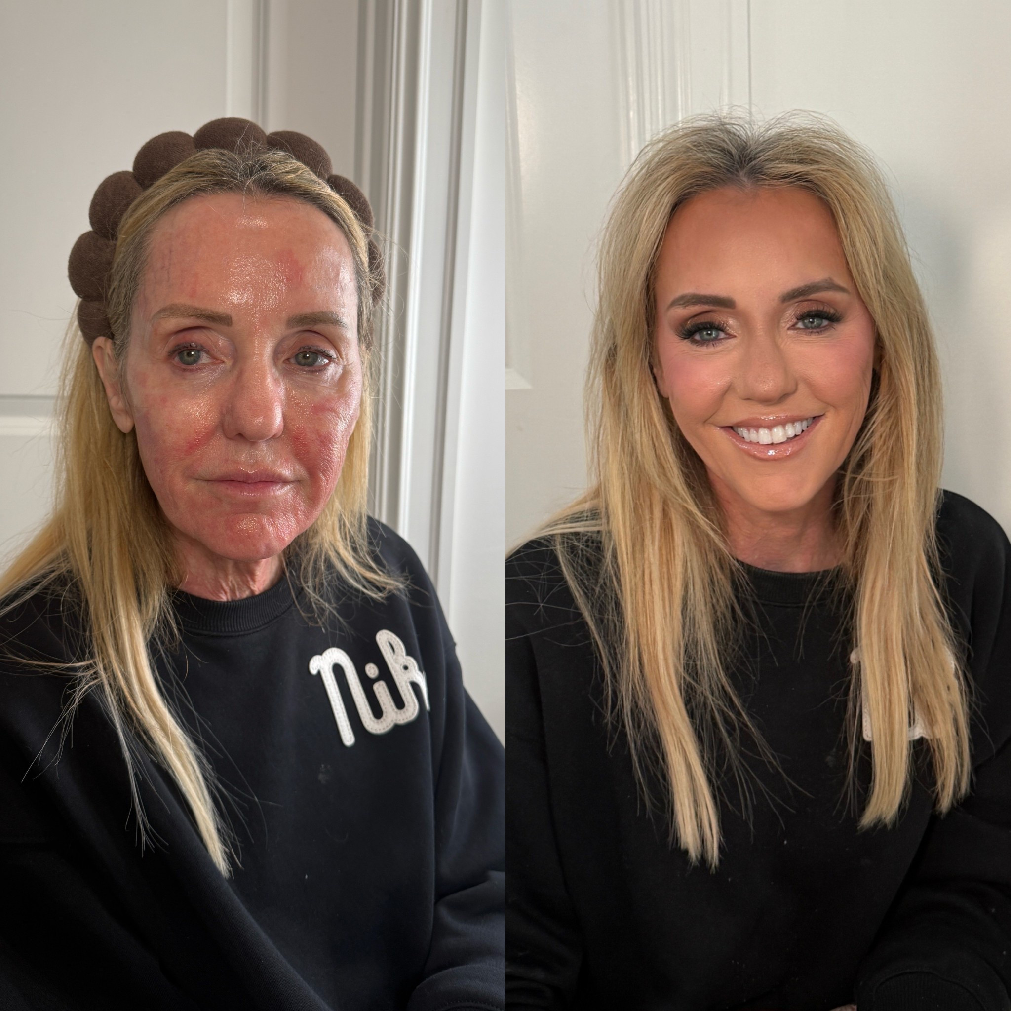 My mom’s birthday is today so I did her makeup! I used my products and the routine I have saved on my makeup collection! It looked amazing! Coco is in her sixties. She just got a laser done yesterday and it’s pretty invasive — she will have the red marks and spots for probably 5 days total but this did a good job hiding it all! A key is to hydrate the skin before - I did a lot of skin prep on her so that no dryness showed through! Makeup over 60, makeup over 50, 

#LTKBeauty #LTKselfcare #LTKgrwm