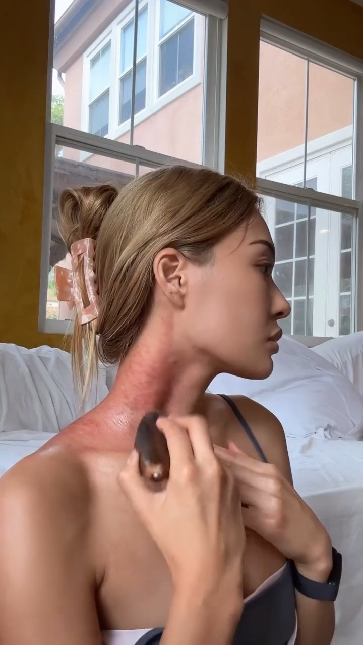 This is the traditional gua sha I grew up with—it’s ancient Chinese treatment, and yes, I know it’s gotten popular lately in the beauty world, but this is the gua sha I know! 

It may look a little intense, but I promise it doesn’t hurt and the relief is instant. It’s incredible for easing tension, stress, and seasonal colds. 

Usually, someone else does it for you, but since I don’t have anyone nearby who knows how, I’ve been doing it myself for years. Every few months, or whenever I’m feeling extra stressed or like I’m coming down with something, gua sha makes me feel totally reset.

Honestly, I’ve been hesitant to share this since it can look kind of intimidating, but this practice means a lot to me. It reminds me of my aunt—the amazing woman who raised me and taught me how to do this as a kid. Sharing this feels like a small way to honor her and my roots.🫶🏼 

#guasha #ancientchinesemedicine