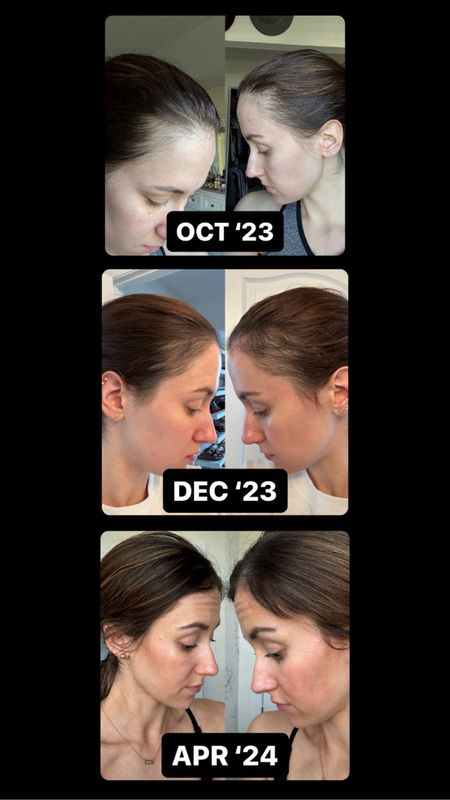 Scalp serum for postpartum hair loss - before + after! 

Postpartum hair care // hair serum // beauty find // hair treatment for hair loss 

#LTKBump #LTKStyleTip #LTKBeauty