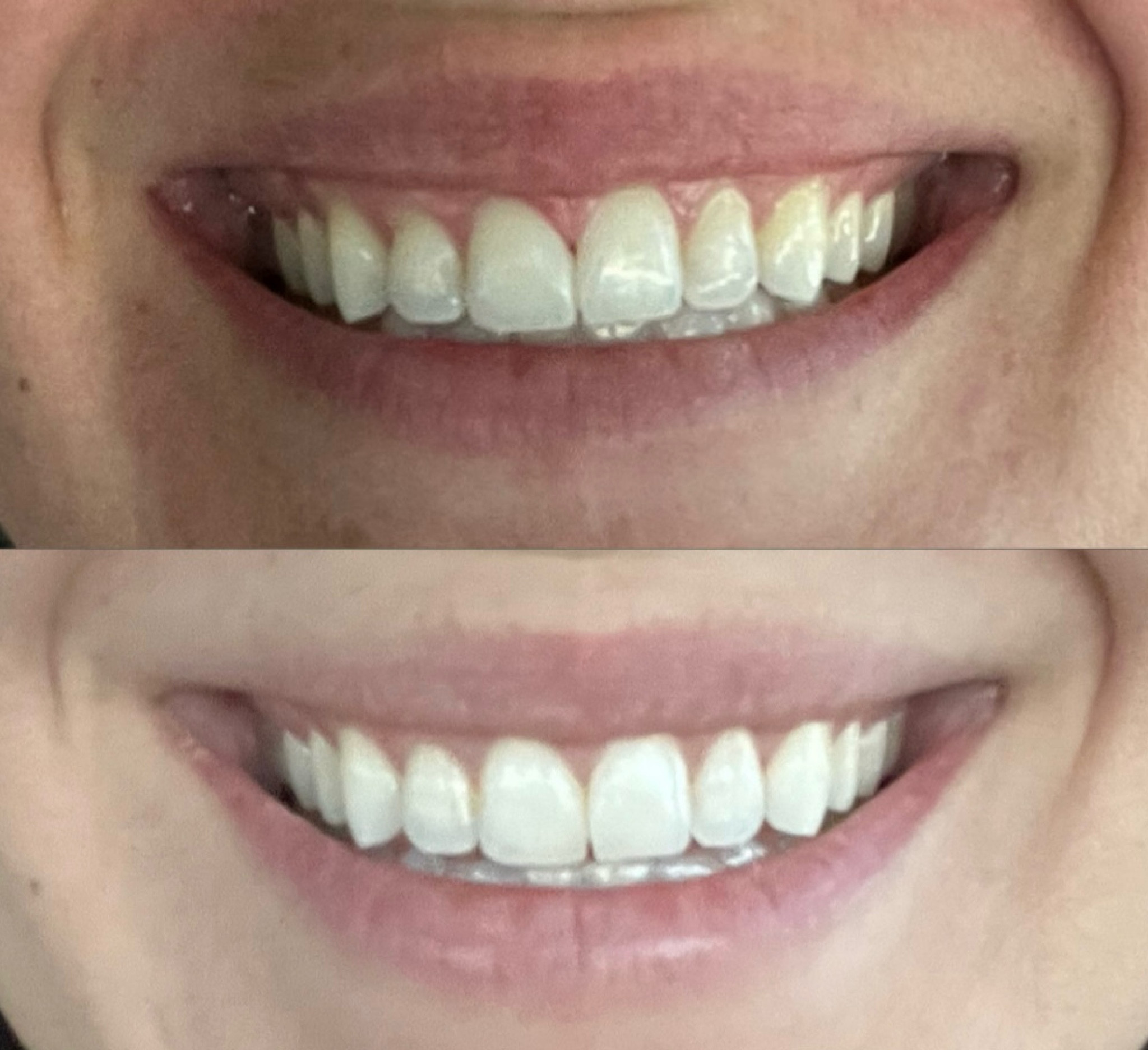 Best teeth whitening for sensitive teeth! I used for 7 days straight and now do 2x a week to maintain 🙌🏼 bonus: it’s a clean, natural product! No chemicals!

#LTKbeauty #LTKfindsunder50 #LTKsalealert