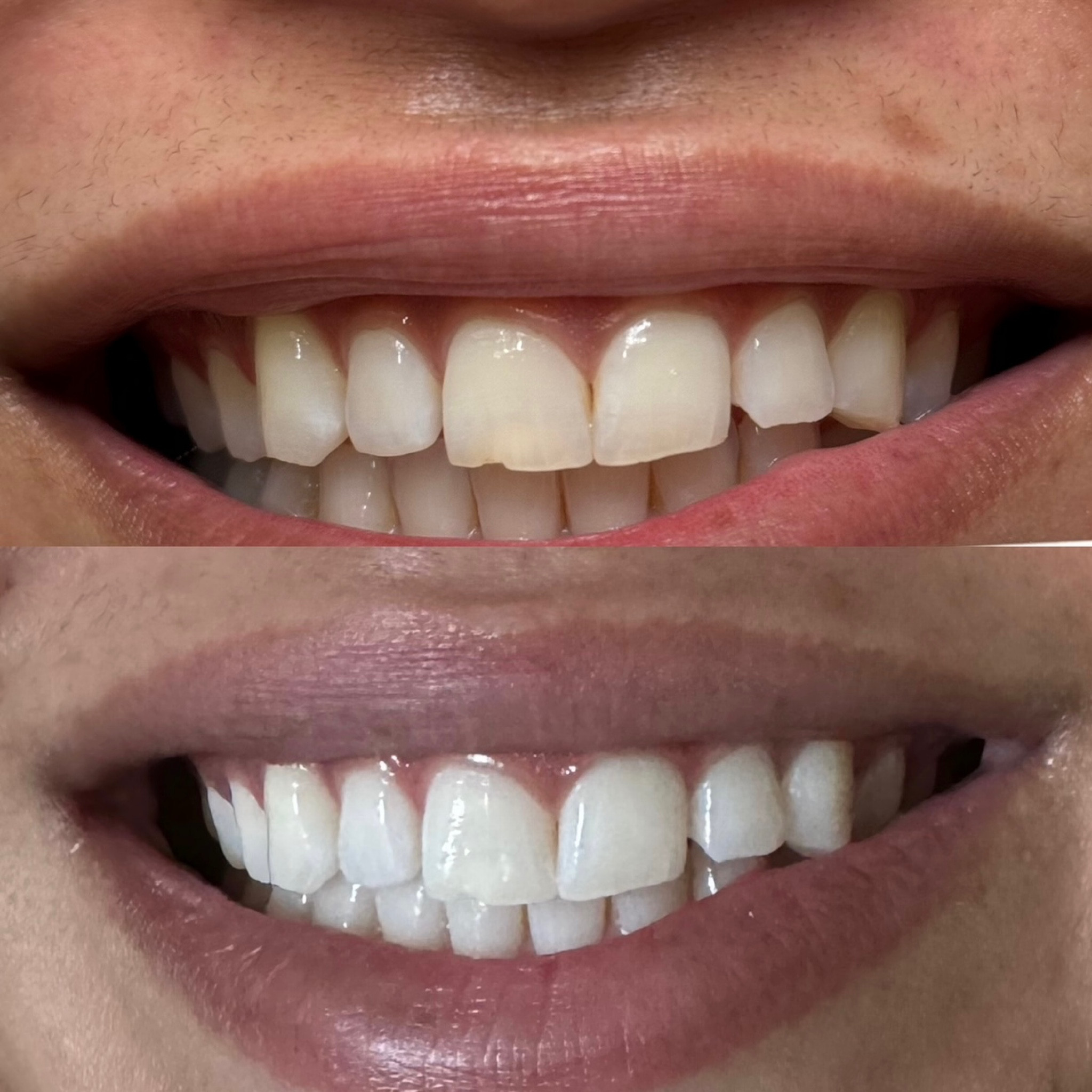 Guru Nanda Teeth Whitening Strips- Affordable, Natural & Effective Teeth Whitening Strips

#LTKbeauty #LTKfindsunder50 #LTKSpringSale