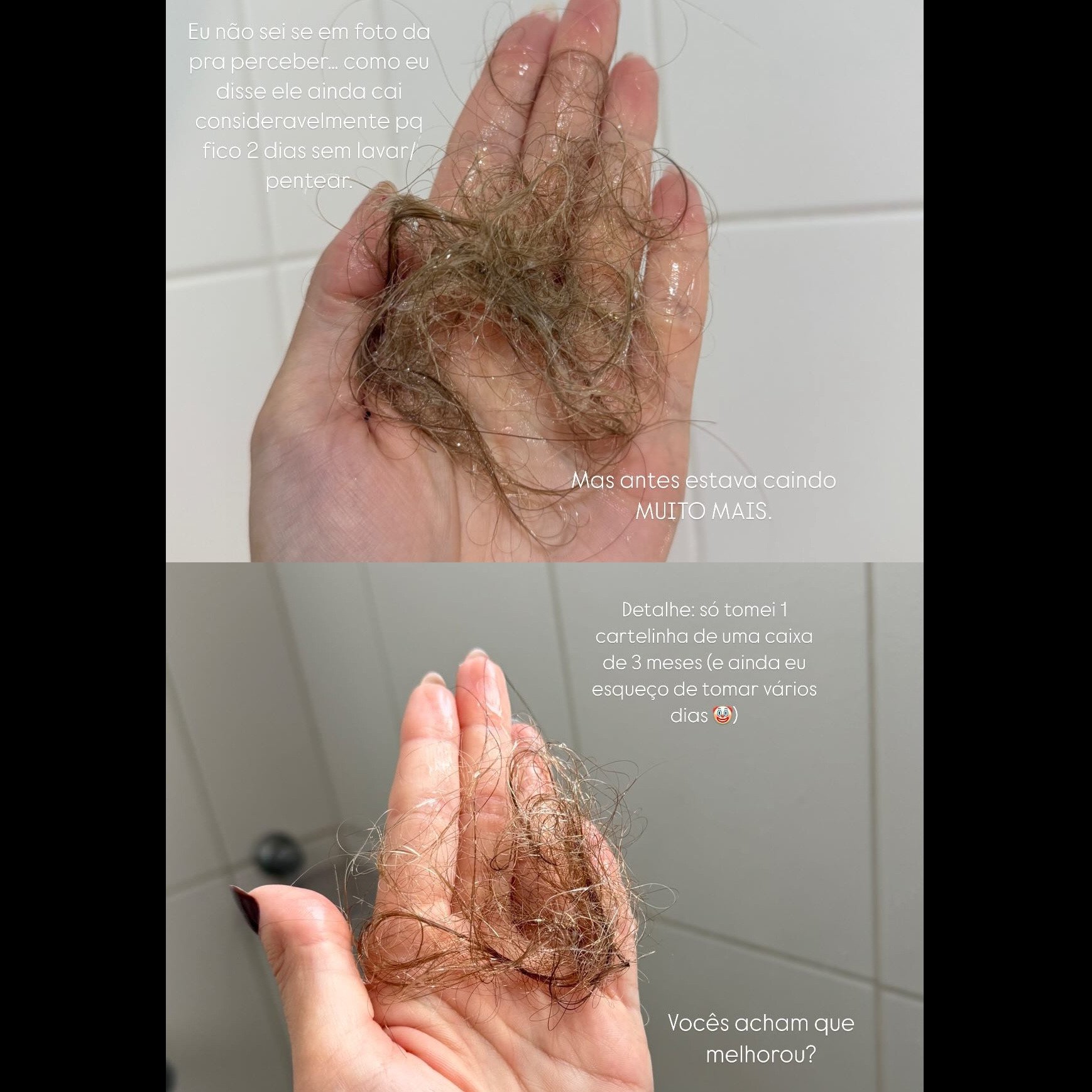 Meu cabelo estava caindo muito! Procurei minha médica e cá estamos: 
Esse é o suplemento alimentar que minha dermatologista me receitou depois de analisar meu cabelo/couro cabeludo e bateria de exames.   Ela me disse que isso seria uma fase de “ataque” drástica pra conter a queda. 
Não é um suplemento barato, eu pesquisei muito antes de comprar também. Mas… comecei a tomar e já estou vendo diferença. 
Por enquanto tomei 17 cp (às vezes esqueço de tomar) e o tratamento é de 3 meses. 
Ela também receitou um tônico, mas esse não estou usando. Continuo usando o da Forever Liss que já estava acostumada. ISSO NÃO É UMA INDICAÇÃO. É um relato rs maas como não é um medicamento e sim um suplemento acho que vale a pena tentar caso esteja passando por isso 🙏🏻 Ela também serve para unhas 💅🏼
Detalhe pesquisei os preços antes de comprar em vários lugares e na Drogaria São Paulo foi o mais em conta 💸

#LTKbrasil #LTKbeleza