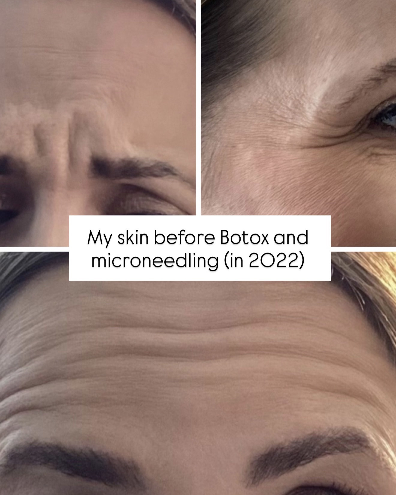 Here are some of the high maintenance things I do to look and feel my best! Anti aging hacks. 
BOTOX: I go every 3-3.5 months and do the majority of units in my forehead where my muscles are most dominant + some in my crows feet area! 
MICRONEEDLING: I’ve tried SO many different systems but I personally love SkinPen! SkinPen is a type of microneedling. I would find someone on your area who does that. You typically need 4-6 sessions to get the results you’re after and can usually purchase a series of 3 to save a little $$ overall. You space them out a month or so in-between treatments. After you’re done with that initial 4-6 treatments - you can usually move to maintenance (maybe for you that’s twice a year - everyone is different). SkinPen is actually more budget friendly than other systems too. Microneedling RF is all the rage but I would personally stay away from it because it can inadvertently target fat in your face and I don’t have a lot of fat to begin with so I don’t want them to accidentally blast that. You are red for 24-48 hours and can wear makeup after 48 hours so recovery isn’t bad at all!

#LTKmorningroutine #LTKBeauty #LTKgrwm #LTKselfcare #LTKmorningroutine #LTKBeauty