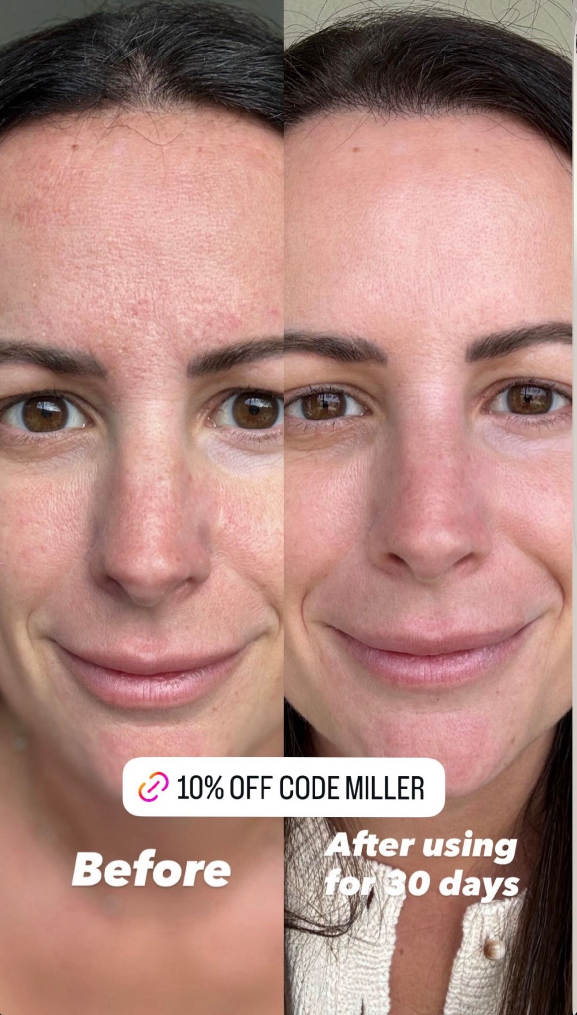 Skin differences after 30 days of consistent use!!! Huge difference in texture! 

#LTKBeauty #LTKmomlife #LTKSaleAlert