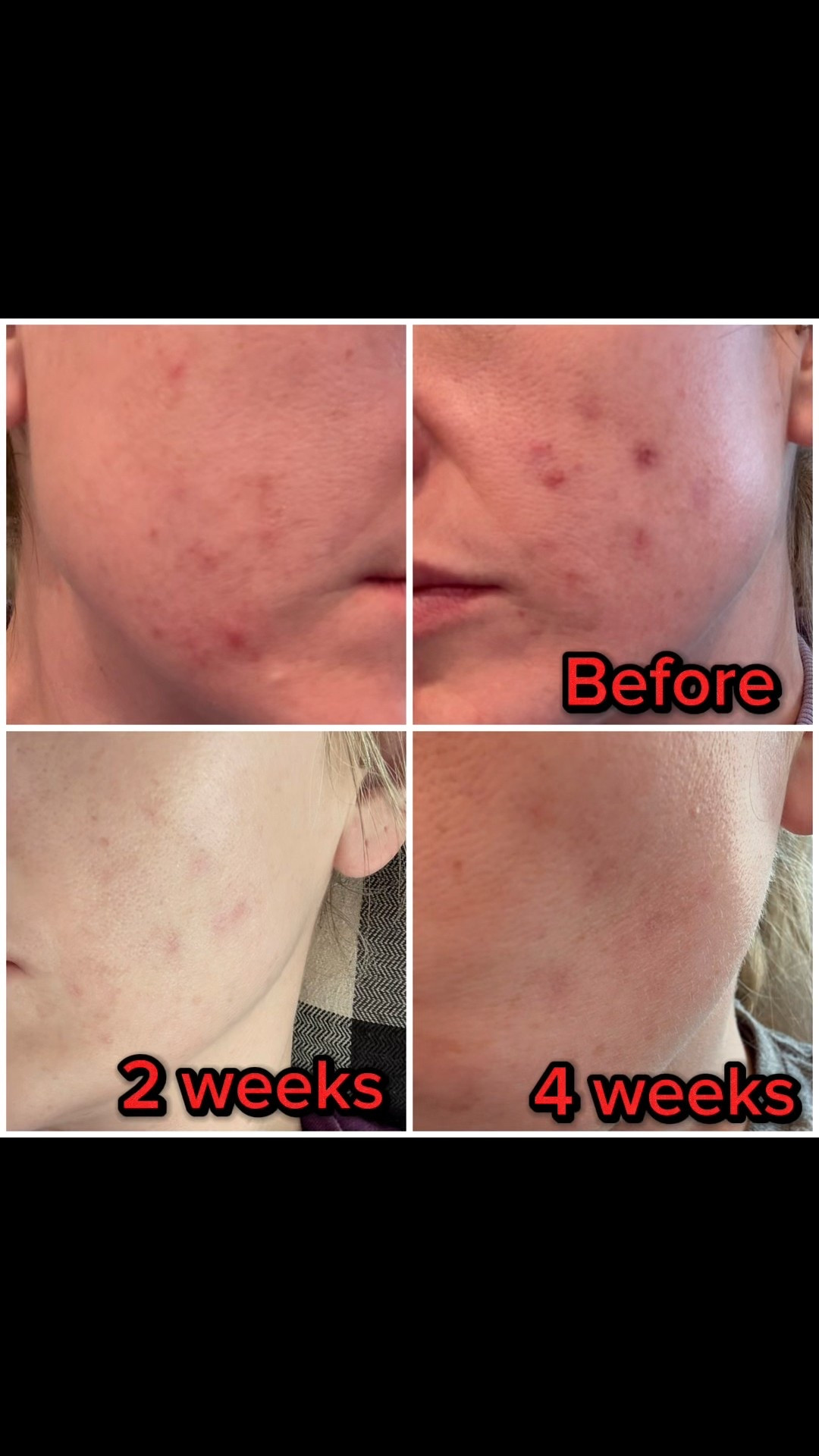 If you struggle with acne this is a game changer! 4 weeks in and my face is almost completely cleared and it has even started lightening my acne dark spots! I am obsessed! 

#LTKFamily #LTKMens #LTKBeauty