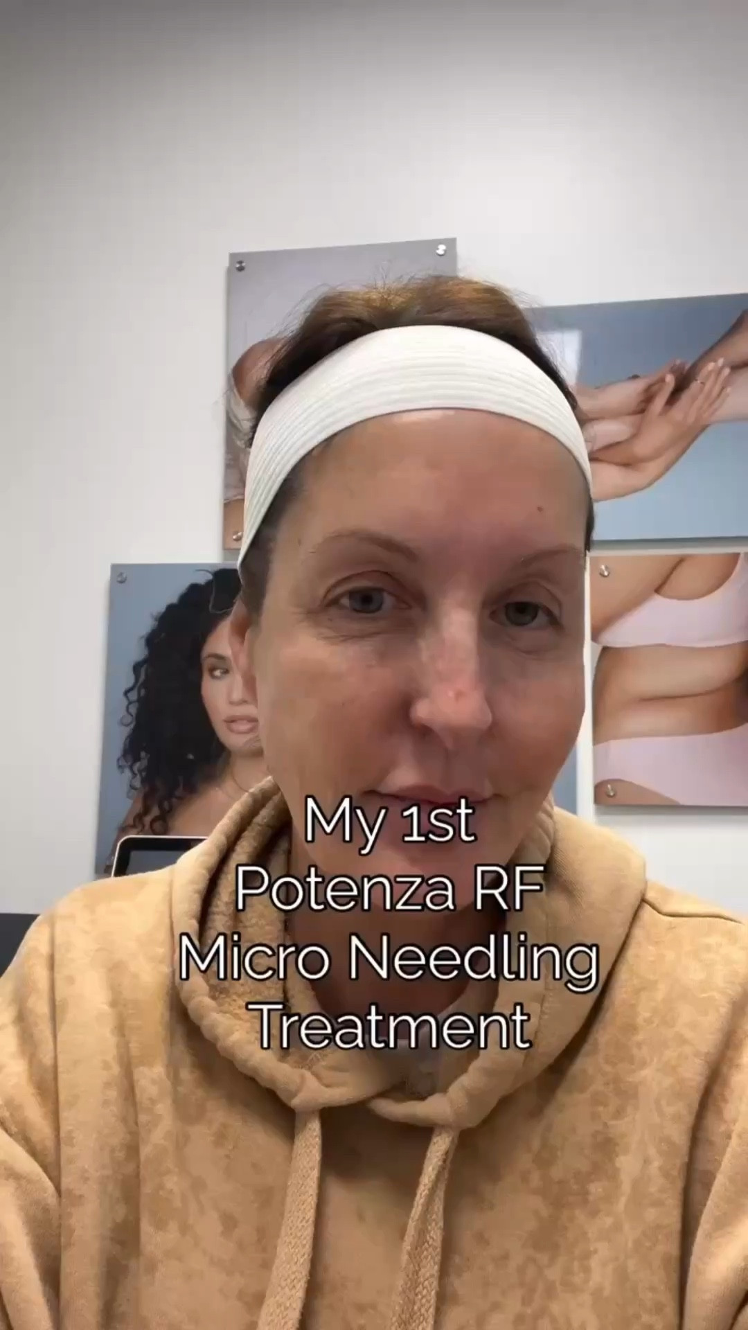 54 years old…No filters, no makeup…Have you tried Potenza RF micro-needling? I recently visited Laser Away to address my post menopausal skin struggles. Just like every woman my age, I am trying to combat fine lines and wrinkles, dull skin tone, discoloration, etc. This was my first time doing Potenza and I’m excited to see results over the next few treatments. For best results, a minimum or three treatments is recommended, but how many depends on your specific skin issues.  I’ll share the progress with you all after my third treatment.  I will have before and after pics to share in case you are considering this treatment.  If you have done Potenza RF, I would love to hear you feedback! Comment below! 

#potenza #potenzarfmicroneedling #laseraway #skintreatment #matureskin #beautycommunity

#LTKdayinmylife #LTKselfcare #LTKBeauty
