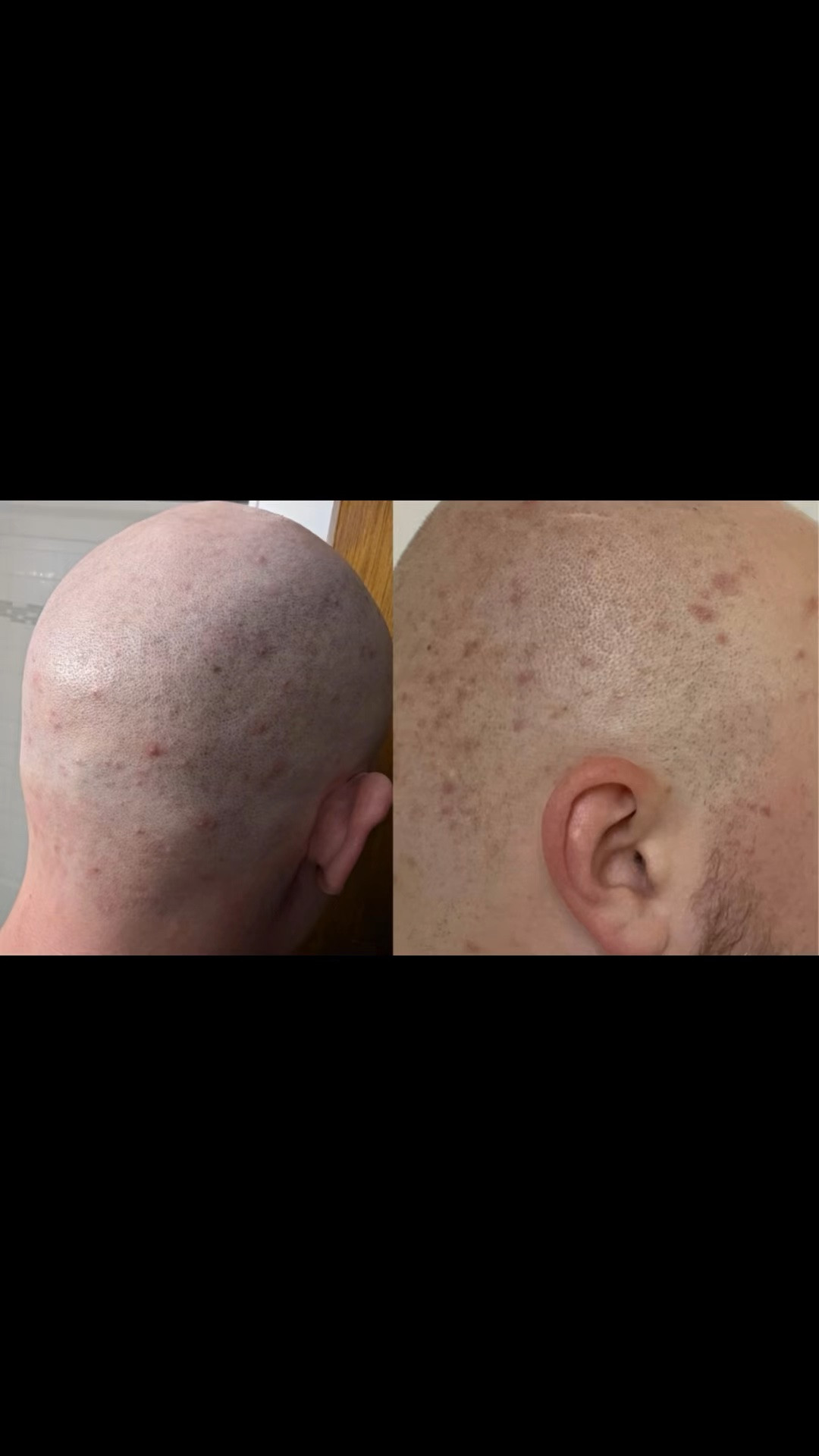 Ingrown hair

#LTKselfcare #LTKSaleAlert #LTKBeauty