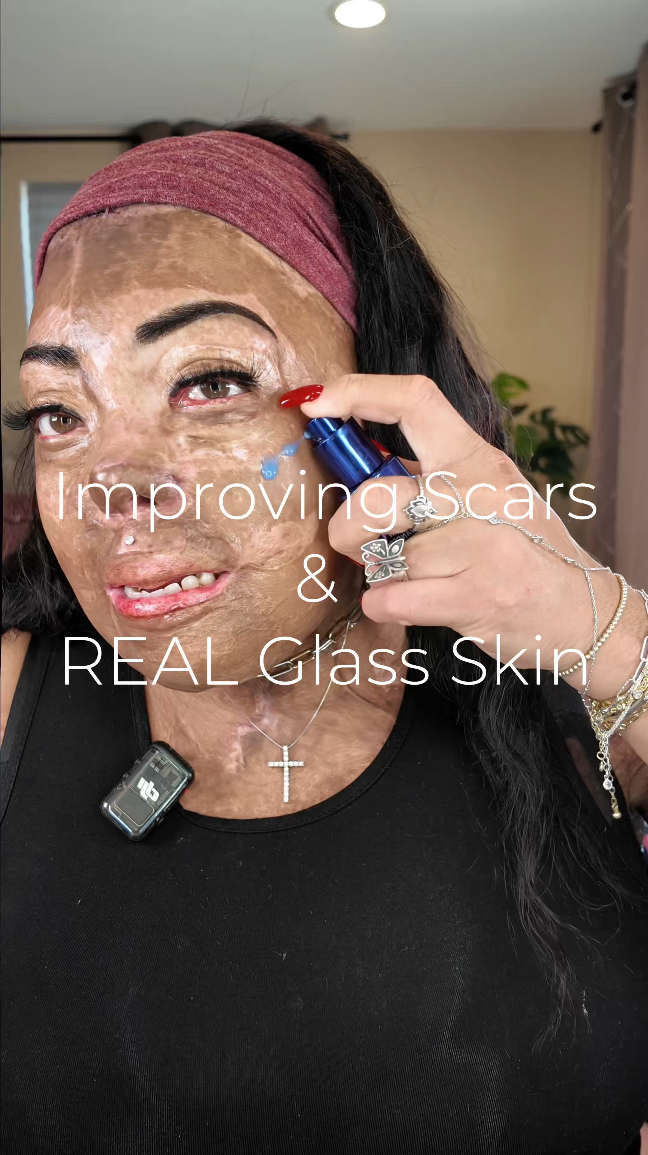 Allies of Skin Copper Tripeptide & Ectoin Serum and C14 Bakuchiol Firming Oil✨

#BetterSkinFast

third-degree burns, improve appearance of scars, glass skin, best face oil, best skin care


#LTKWatchNow #LTKOver40 #LTKBeauty