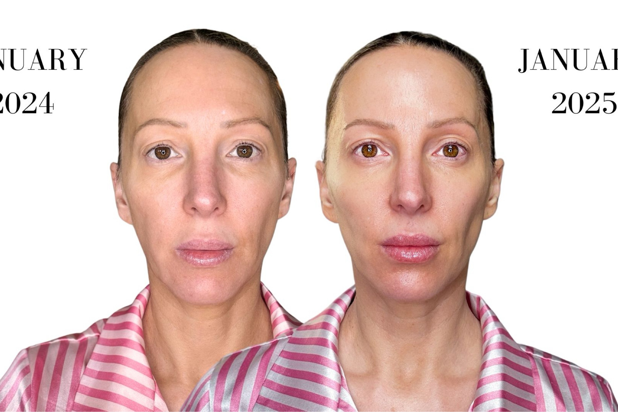 Does ziip halo work? The answer is in the results. Use discount code EVAD for 10% off all Ziip devices and gels. 

#LTKOver40 #LTKSaleAlert #LTKBeauty