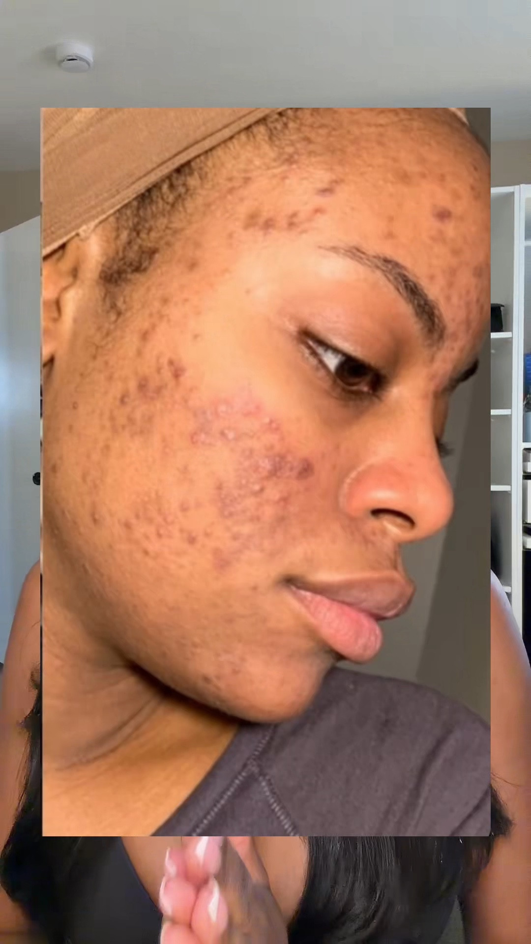 How to cover dark spots and hyperpigmentation 🤎🙌🏾 






#darkspots #fullcoveragemakeup #fullcoveragefoundation #colorcorrector @Morphe Cosmetics @LYS Beauty @NARS Cosmetics @Patrick Ta Beauty @Laura Mercier @Estée Lauder 

#LTKgrwm #LTKselfcare #LTKBeauty