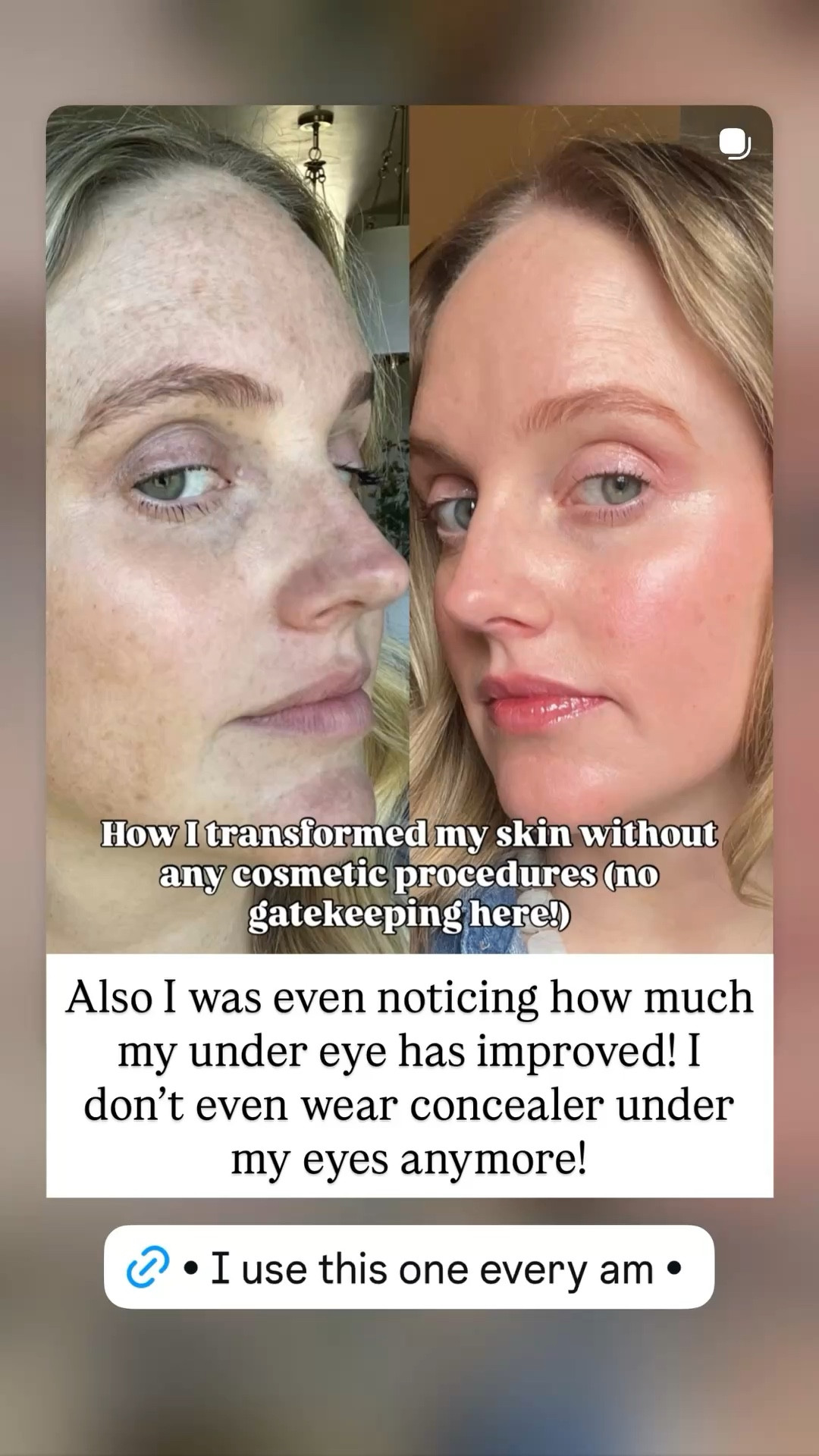 Also I was even noticing how much my under eye has improved! I don’t even wear concealer under my eyes anymore!

#LTKBeauty #LTKmomlife #LTKselfcare