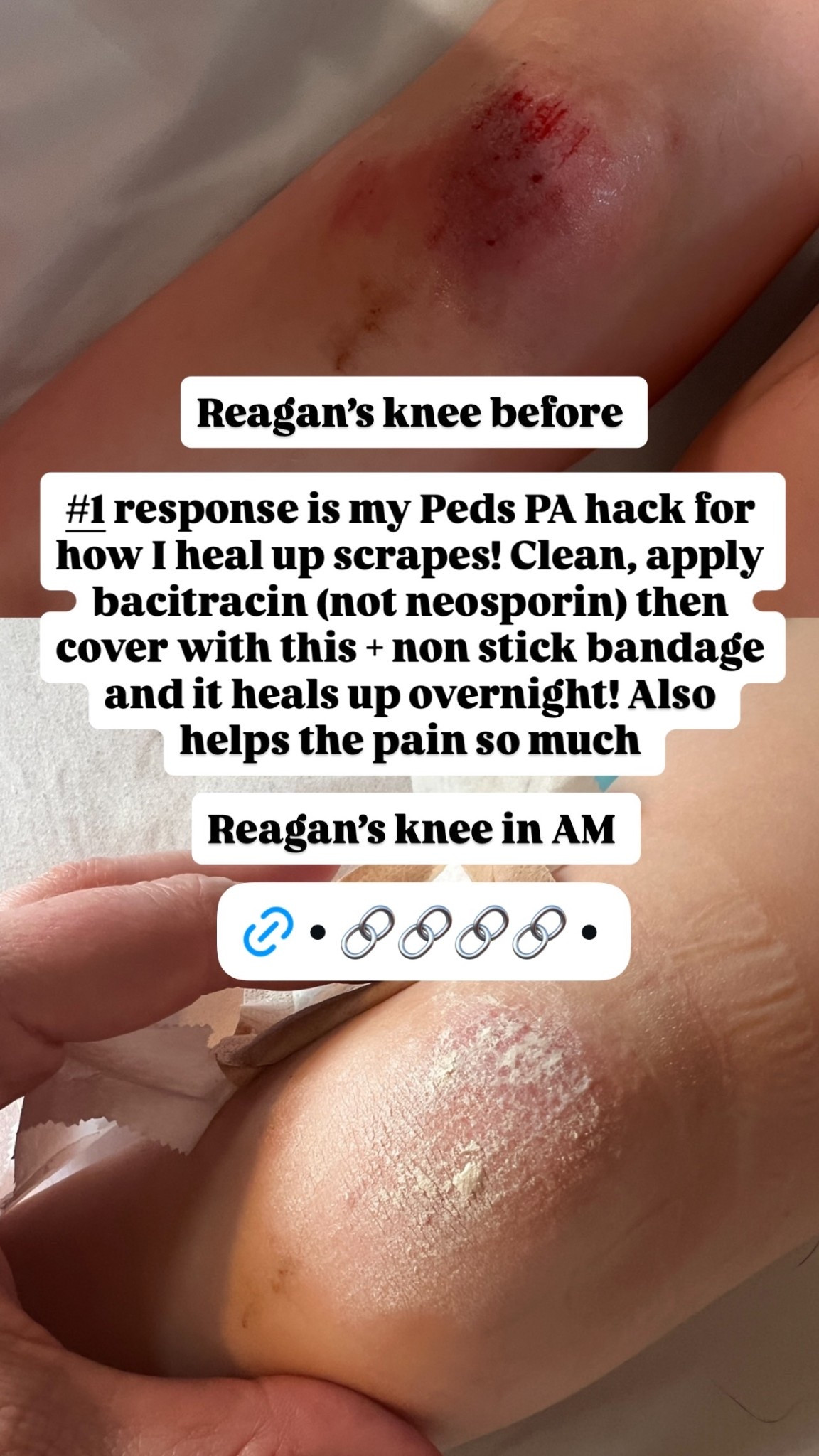 Reagan’s knee before  Reagan’s knee in AM  #1 response is my Peds PA hack for how I heal up scrapes! Clean, apply bacitracin (not neosporin) then cover with this + non stick bandage and it heals up overnight! Also helps the pain so much

#LTKmomlife #LTKSeasonal #LTKKids