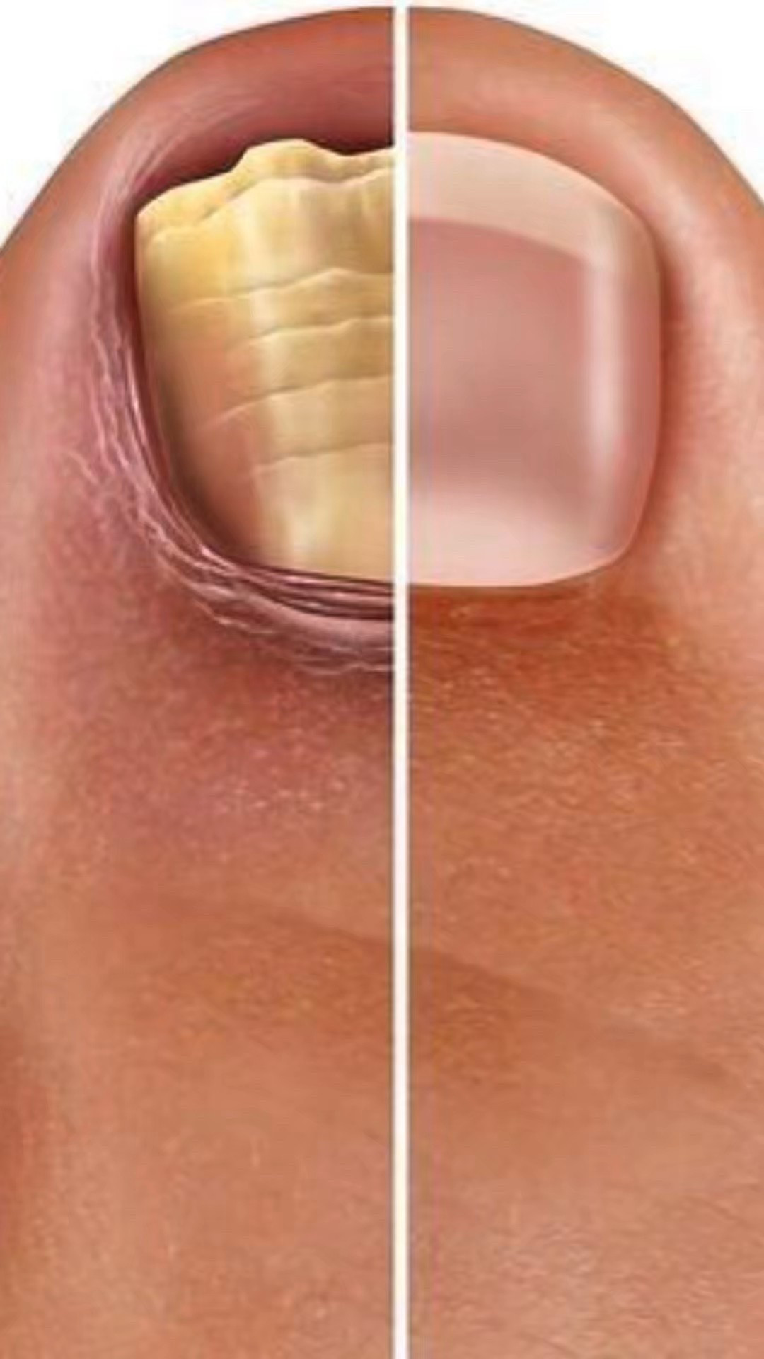 The Lunavia Fungus Treatment Pen is specially formulated to target nail fungus at its source, helping to restore the natural clarity, strength, and appearance of your nails. Its advanced formula penetrates deeply for effective results, while the sleek, easy-to-use pen design ensures precise and mess-free application. Ideal for incorporating into your daily routine, it supports the gradual improvement of nail color and texture, promoting healthier-looking nails you can feel confident about.

#LTKSaleAlert #LTKActive #LTKBeauty