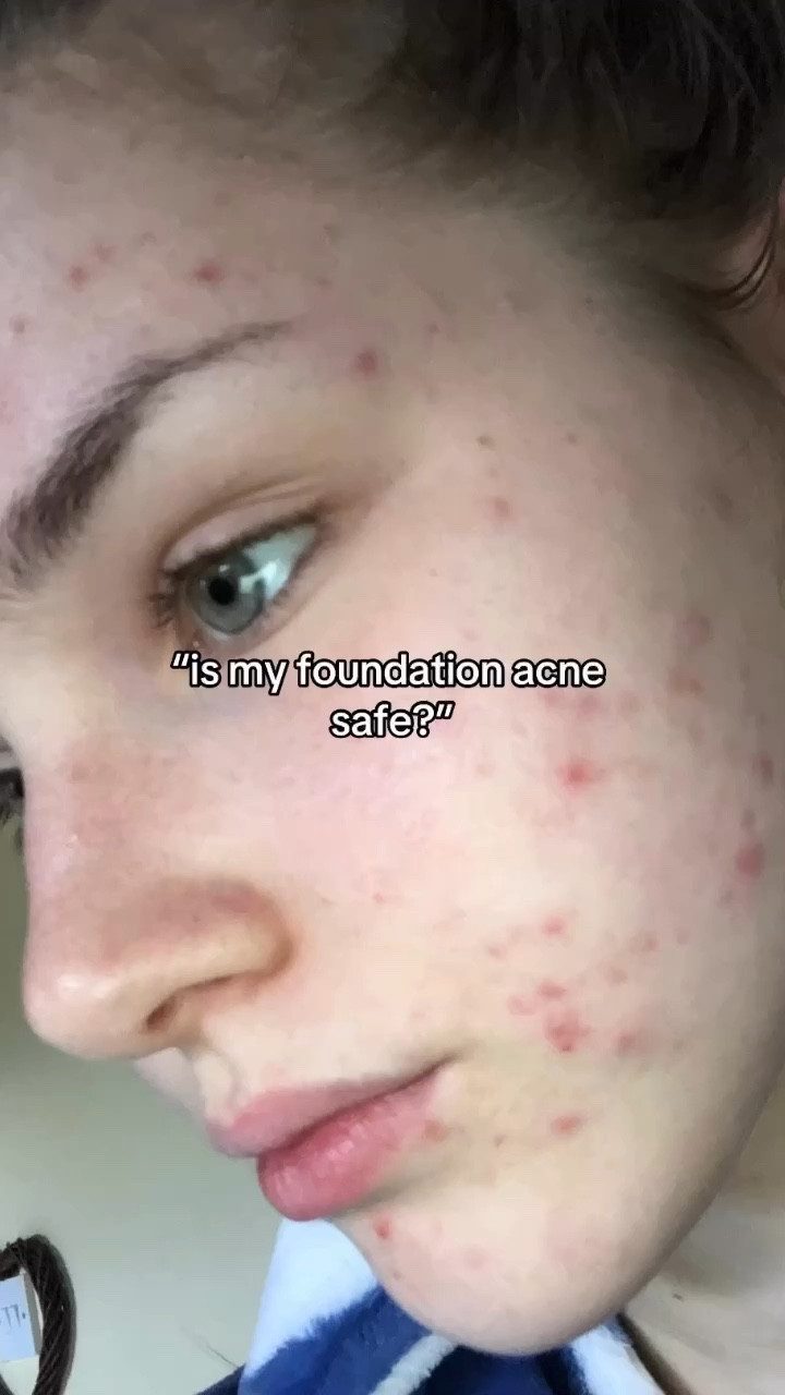 acne safe foundations!!



acne safe makeup, acne, skincare, makeup, summer makeup, acne prone skin

#LTKeurope #LTKsummer #LTKbeauty