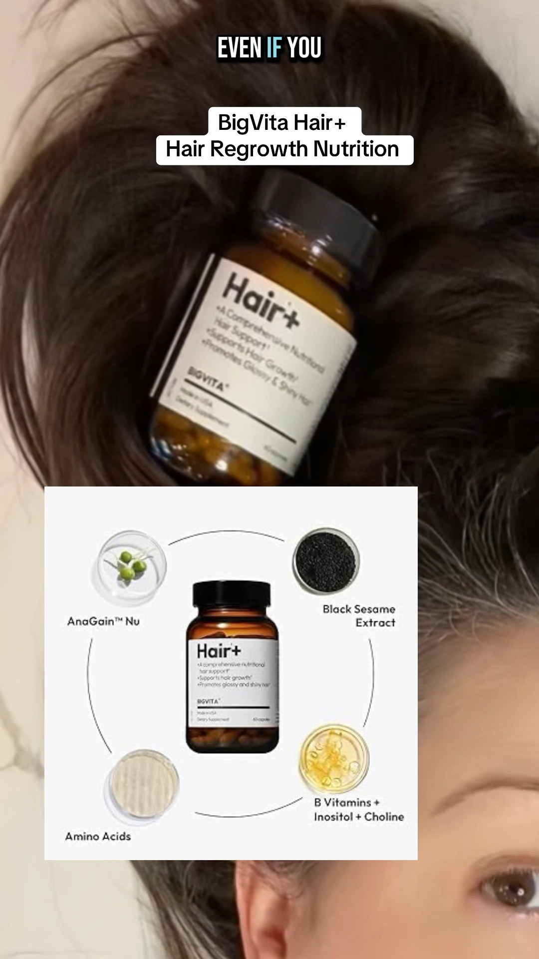 I started taking this @BIGVITA Hair Hair+ Supplement that supports the nutritional foundation for follicle health and hair regrowth. You don't always have to live with hair loss permanently, but you do need nutritional support in the fight back. I love this and will continue to post updates on my chronic illness and hair growth journey #hairloss #hairgrowth #supplement #hairgrowth #vitamins #minerals #boost #longhair #thickerhair #chemotherapy #autoimmune #postpartum #perimenopause #menopause #stress #trichotillomania #regrowth #support #SelfCare #fyp #foryoupage

#LTKFindsUnder50 #LTKOver40 #LTKBeauty