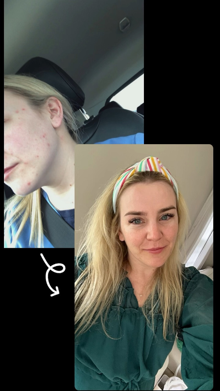 ✨ How I transformed my skin: I start with the Fresh Soy Hydrating Gentle Cleanser for a clean, refreshed base. For any breakouts, I rely on the Control Corrective Acne Spot Treatment to clear things up. Next, I apply The Ordinary Niacinamide and Zinc Serum to keep my skin smooth and balanced. Finally, I lock in moisture with the Fresh Youth Preserve Moisturizer, leaving my skin glowing all day. #SkincareRoutine #GlowUp 

#LTKBeauty