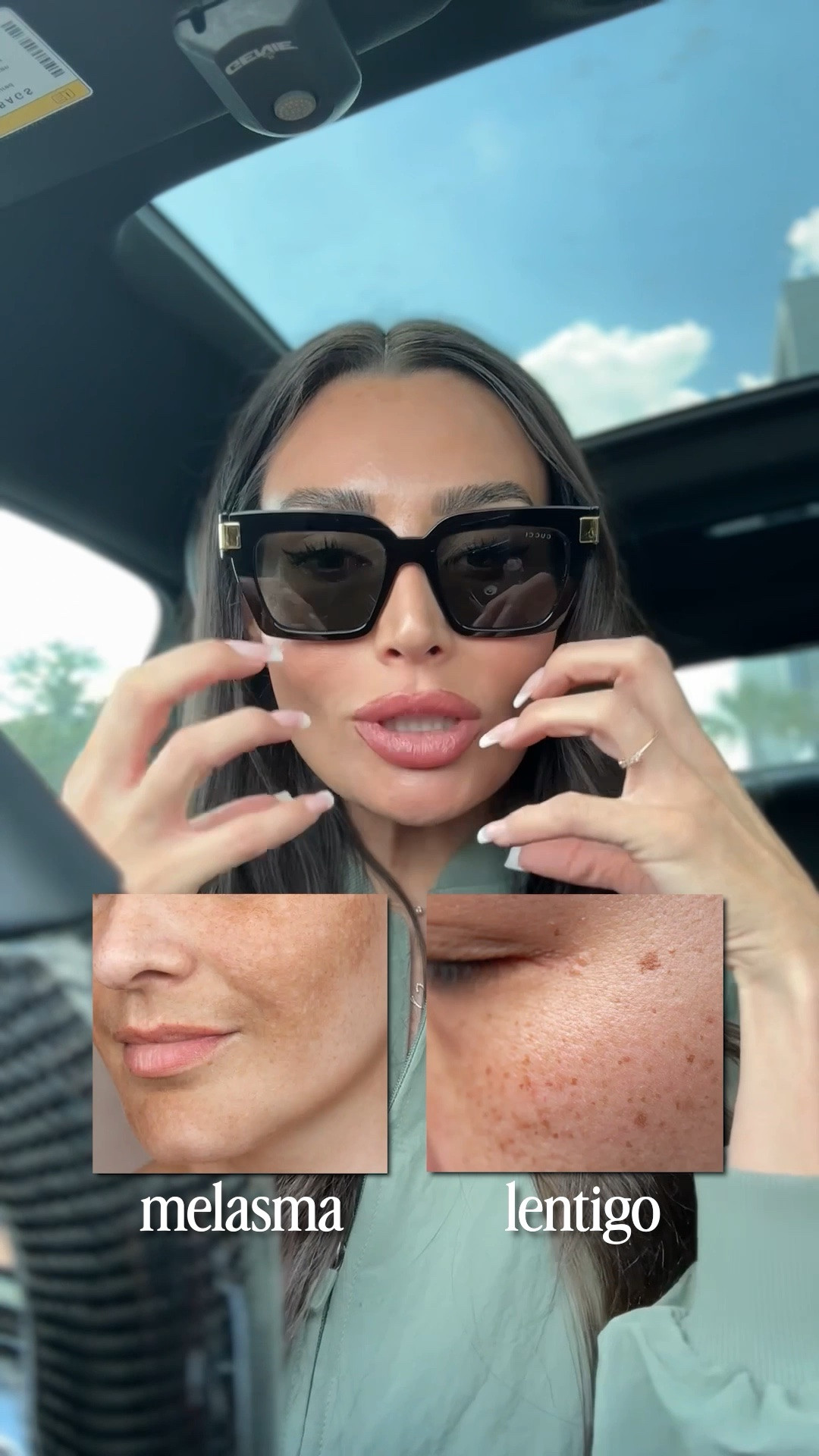 There’s so much to say about melasma, but as you can see, there are many different ways that we need to treat it and keep it at bay.  It’s more than just a one and done thing, but having a solid skin care routine is so important.

This is what works for me:

AM:
Gentle cleanser 
Barrier spray
Vitamin c
Brightening serum/cream
Azaleic acid
barrier cream 
Tinted mineral spf over 40 spf (best for melasma)

PM:
Barrier spray/toner
Brightening serum/cream
Retinol/retinal/tretinoin etc 
Barrier cream
*adding in chemical exfoliating serums/pads a few times a week is helpful! 

#LTKgrwm #LTKselfcare #LTKBeauty