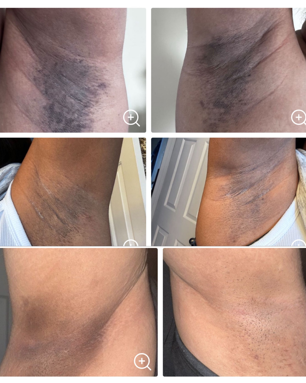 Cuando quedé embarazada, lo primero que noté fue como empezó oscurecerse todas mis zonas en la búsqueda de aclarar mi zona íntima me conseguí con este Review que me dejó impactada definitivamente esta compra la haré hoy s

#LTKCyberWeek #LTKmomlife #LTKBeauty