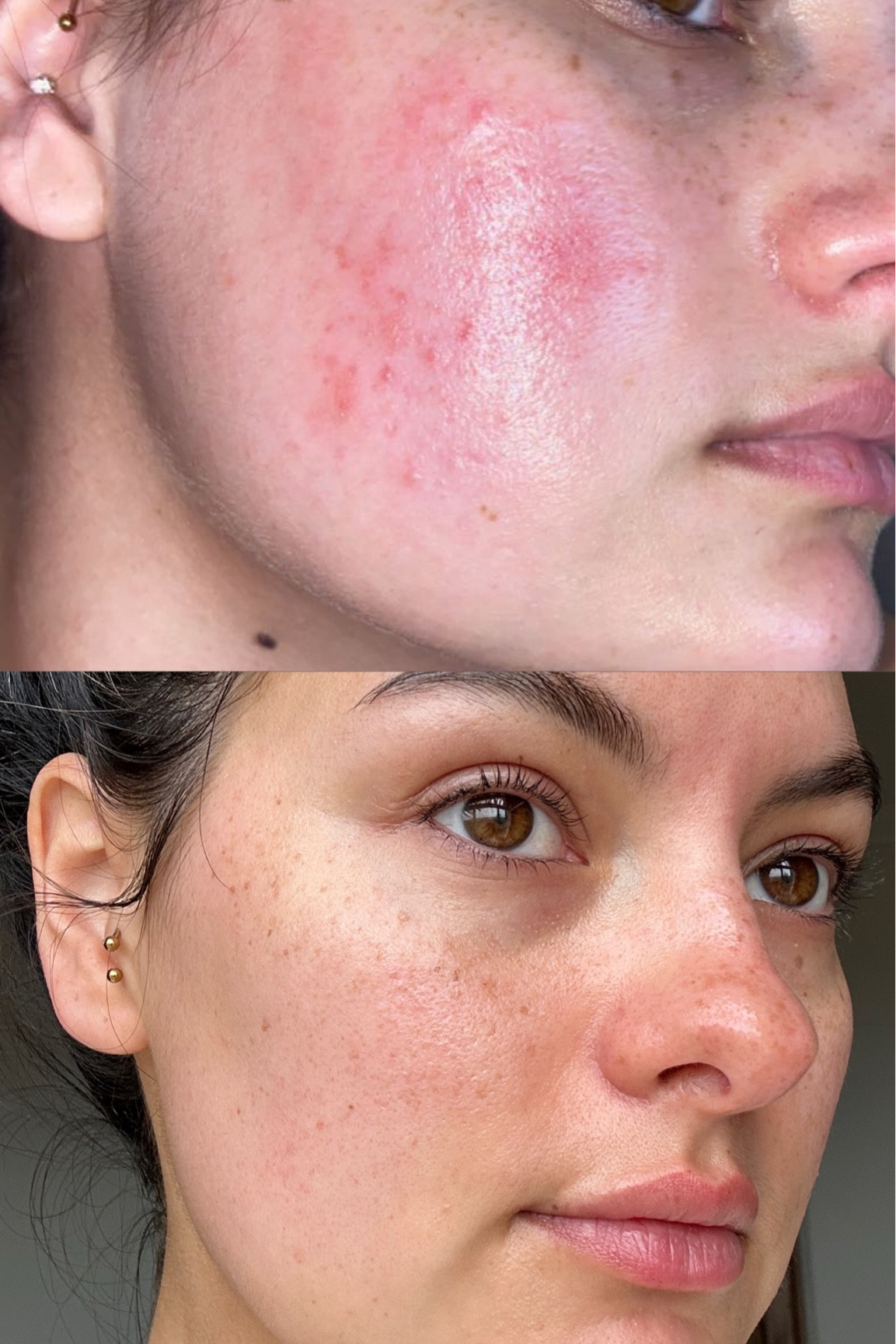 products that have helped heal my rosacea 🫶🏻

#LTKSaleAlert #LTKFindsUnder50 #LTKBeauty