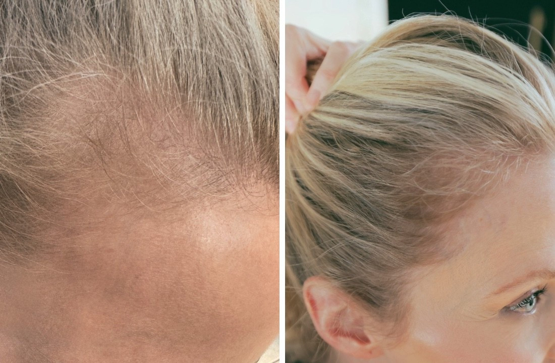 I have had so many women ask for my secret on how my hair is so thick, voluminous, and frankly…gorgeous lately. I’ve struggled with thinning hair and decided to go full in on testing out Nutrafol. The results are amazing! I’m seeing less shedding, more growth, filling in along the hairline, and a very exciting confidence boost. The before and after speaks for itself. 

#LTKBeauty #LTKOver40 #LTKselfcare