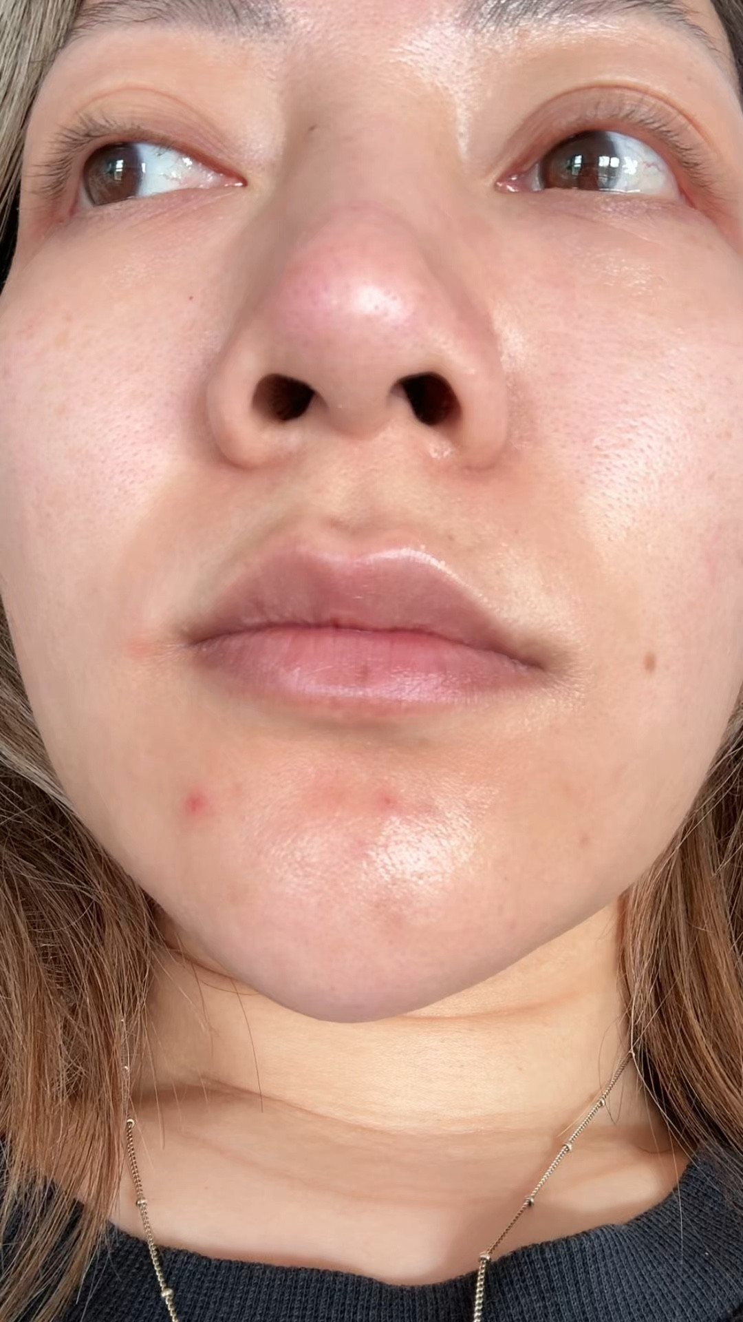 Healing my skin barrier - adult breakouts 

#LTKbeauty