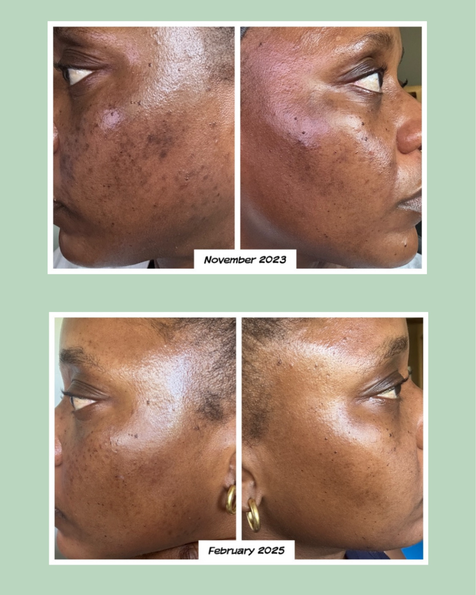The skincare products that helped my hyperpigmentation improve  

#LTKBeauty