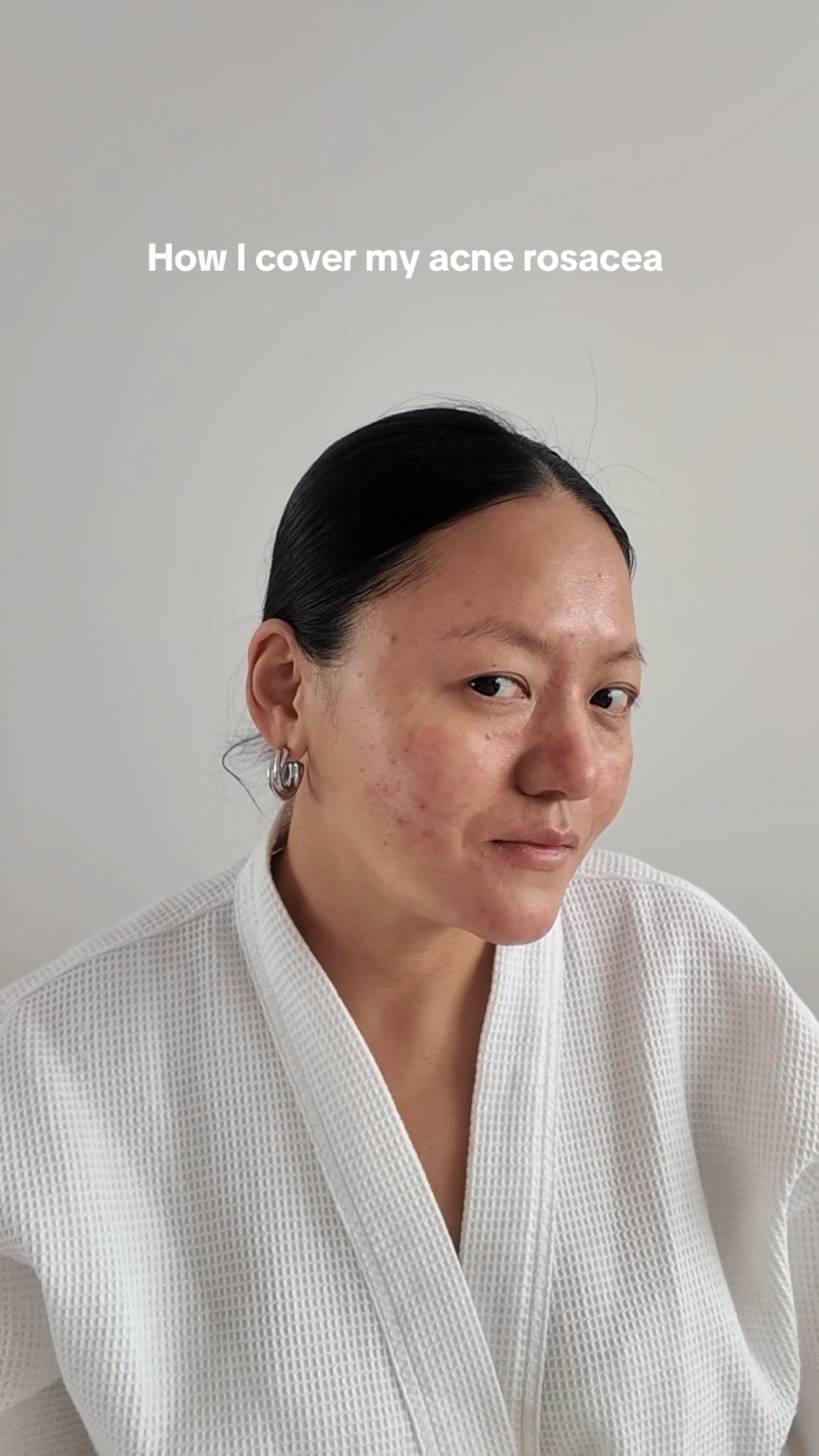  A simple & easy way to cover acne rosacea. 

acne skincare, acne, skin redness, rosacea, sensitive skin, make up, acne make up, sunscreen

#LTKuk #LTKbeauty #LTKeurope