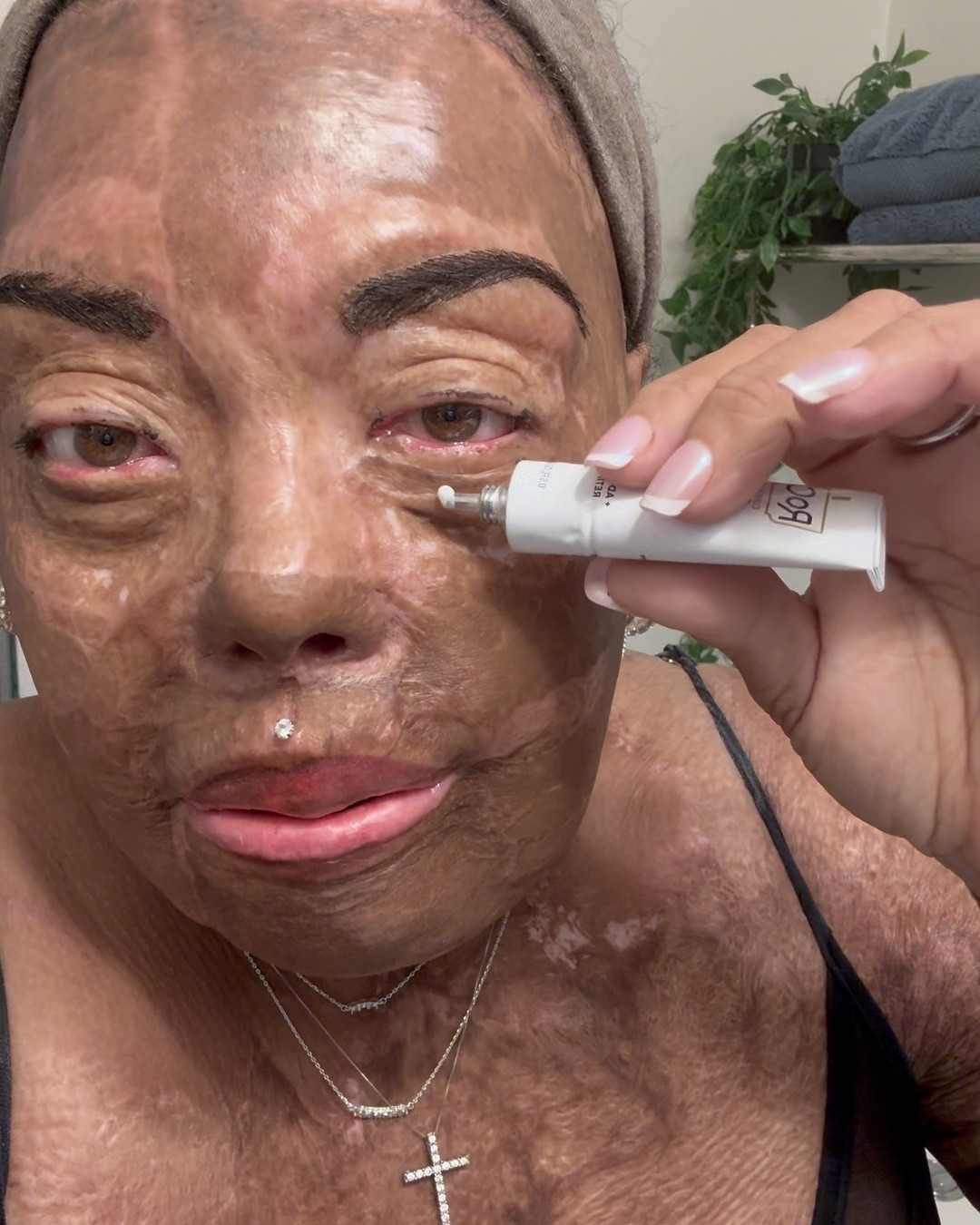 I’m so grateful for my life and for how much my skin grafts have healed, but I still don’t care for the way my undereye looks. The graft was not done properly and there’s not really anything that can be done to fix it, so I do my best to try to keep the puffiness down.

This RoC retinol eye cream works great for that, and it also brightens dark undereyes and smooths fine lines.

#LTKBeauty #LTKOver40