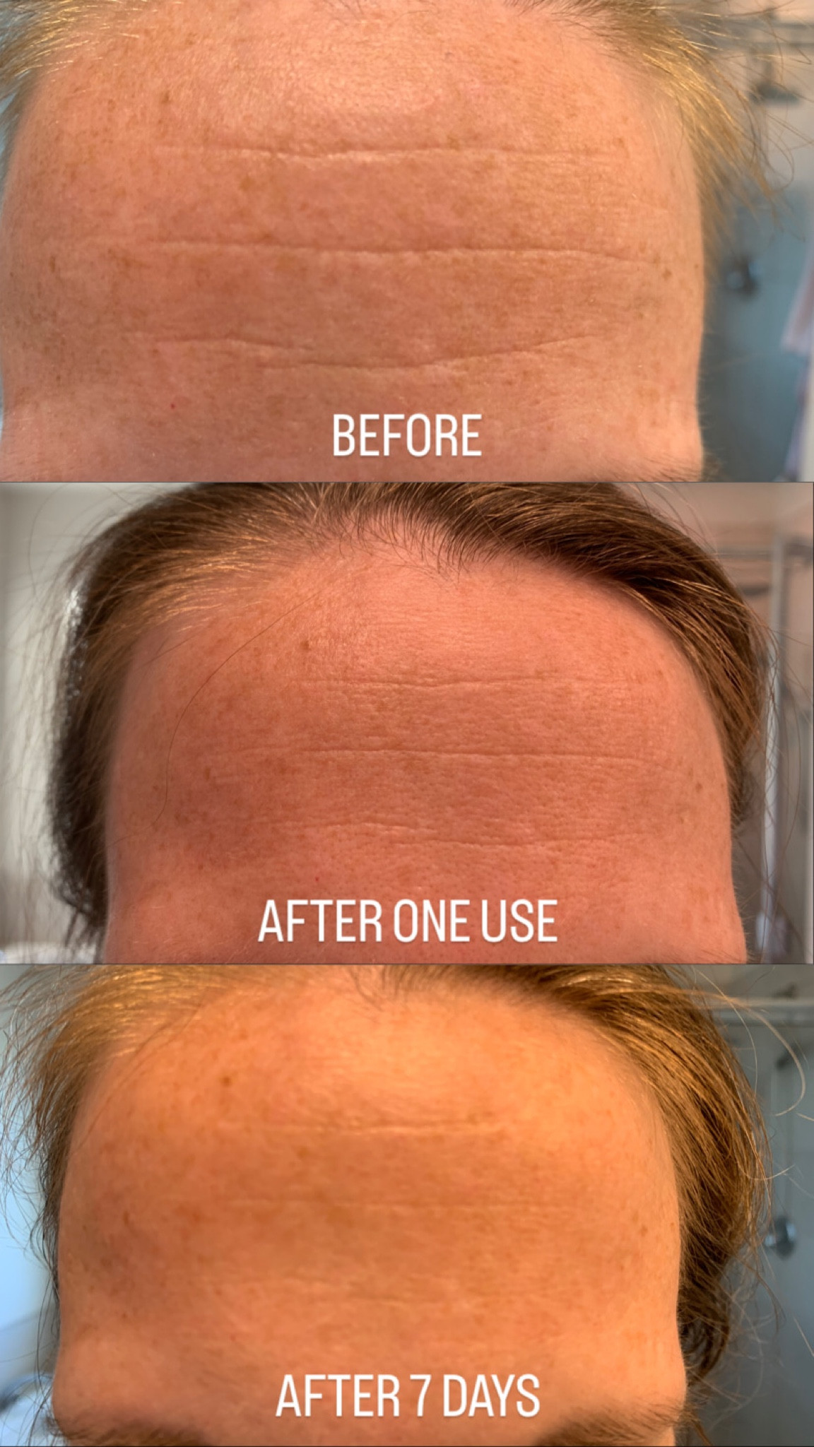 Frownies are the new Botox!

#LTKbeauty