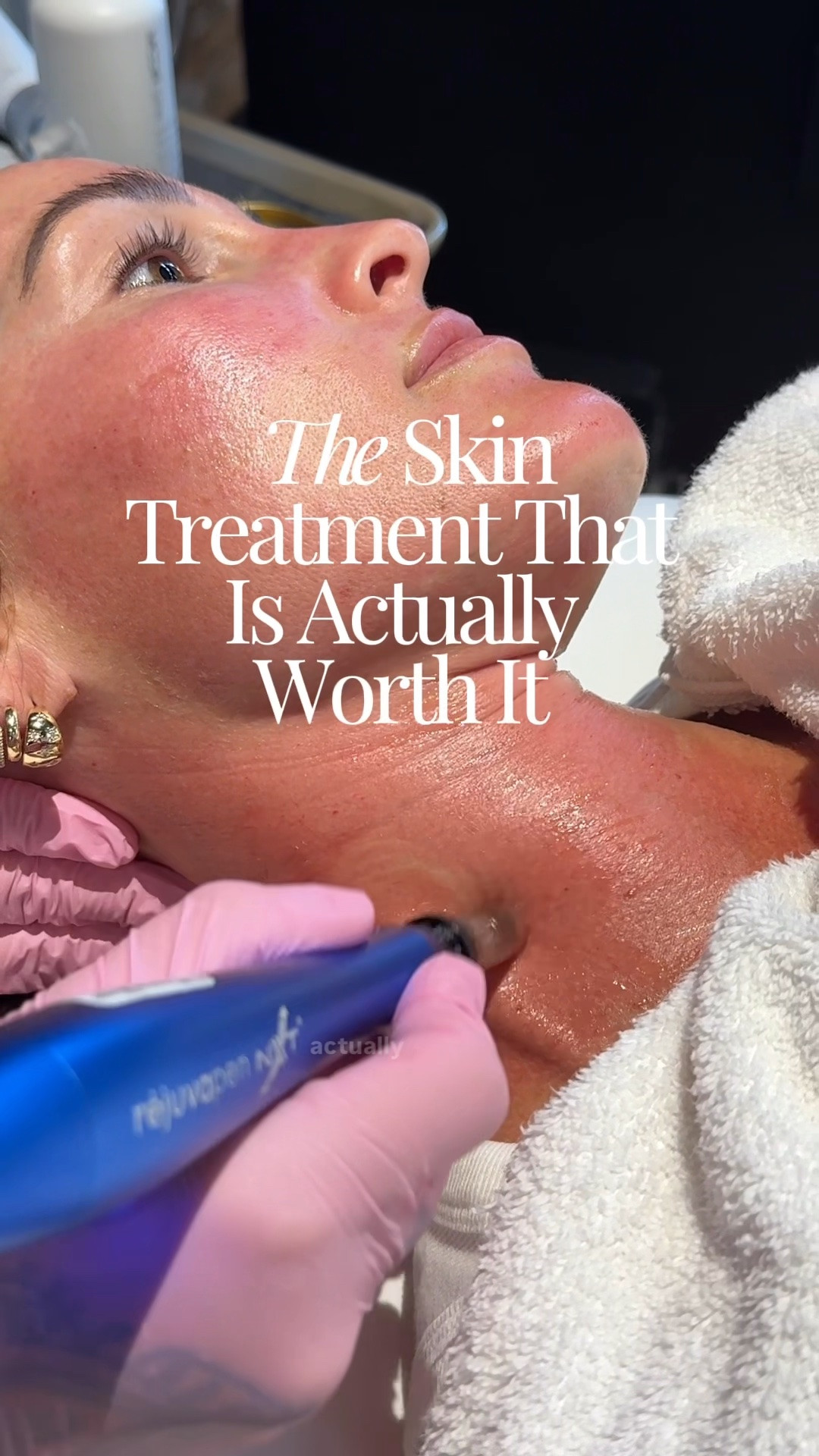 THE skin treatment that is actually worth it!💁🏻‍♀️ Consistent microneedling has changed the texture of my skin! The pen has tiny little needling that puncture the skin and stimulate collagen production - YES please! I’ve been doing it 2-3x/year for the past 4 years. Now that I’m 40 I’m so happy I added this into my skin routine! 

If you want to learn more I have a detailed blog post on SBKliving.com - comment “SKIN” and I’ll send it to your DMs🙆🏻‍♀️

#LTKBeauty #LTKOver40 #LTKselfcare
