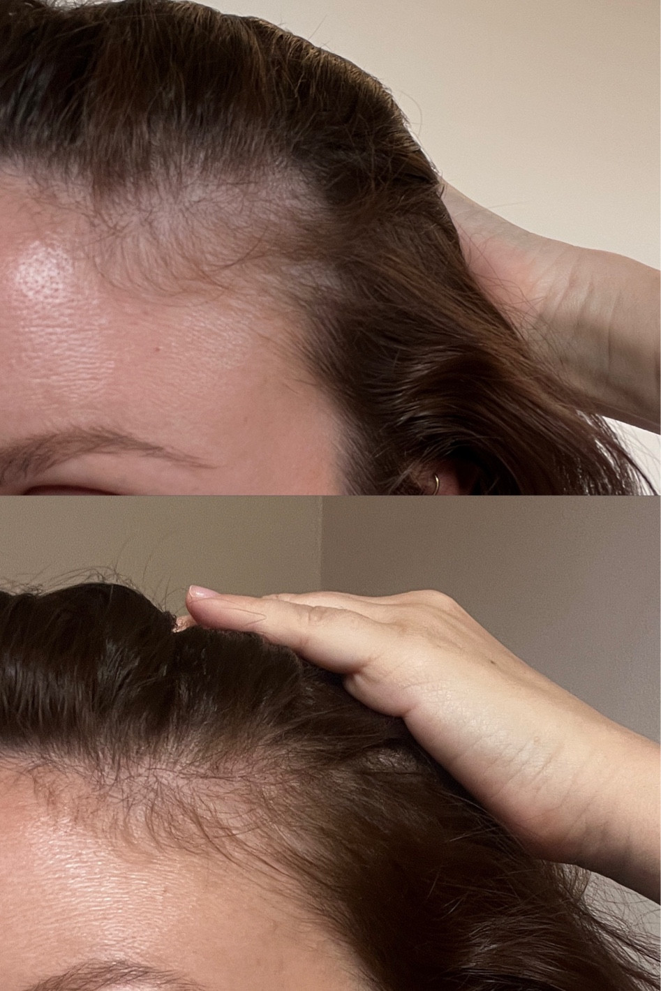 hair growth update! So impressed with how using a supplement and scalp serum daily have made a difference! 