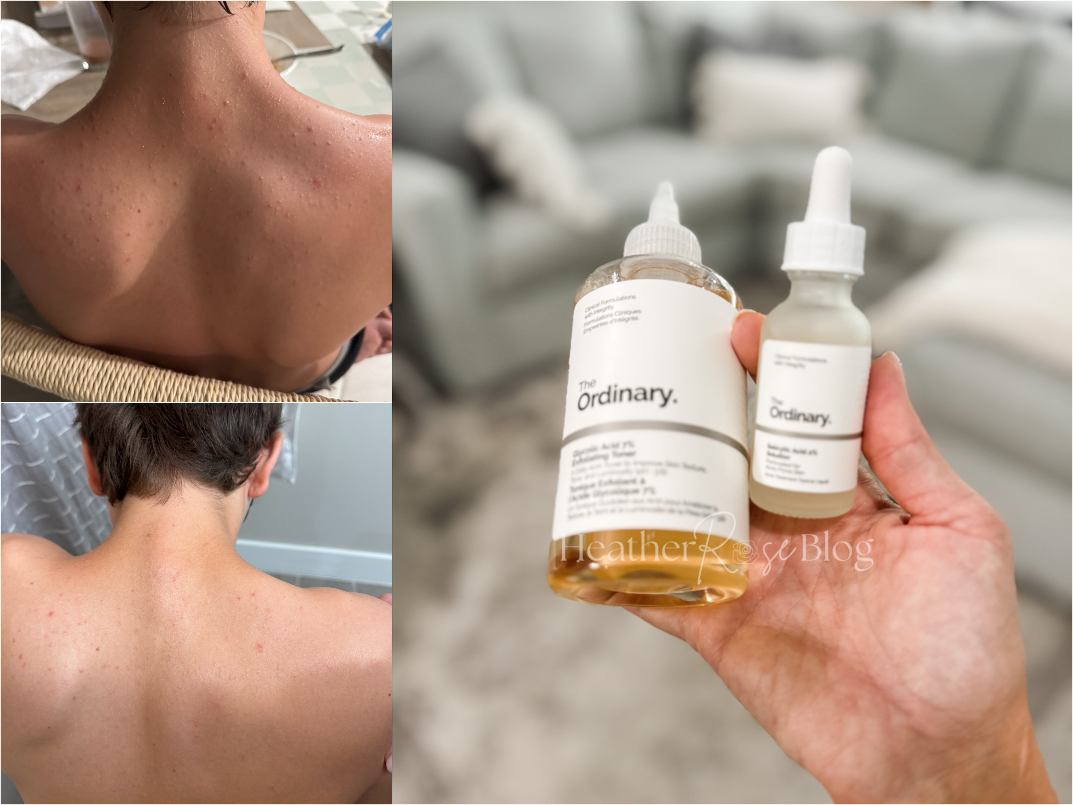 the best combo to tackle acne!!! Clean with the glycolic first then apply the salicylic solution! #founditonamazon #amazonbeauty #cleanbeauty 

 #LTKFindsUnder50 #LTKBeauty #LTKKids