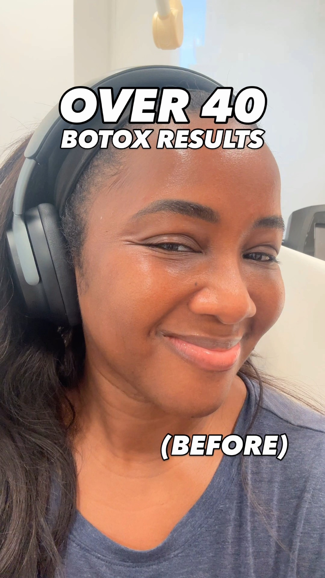 My recent botox results! To learn more about how to find and vet a skin pro near you, comment LINKS. From Threads/Facebook, click this link: https://youtu.be/0MZX4MumStM?si=YBqQ5kP0eXpK4owj

#LTKBeauty #LTKOver40
