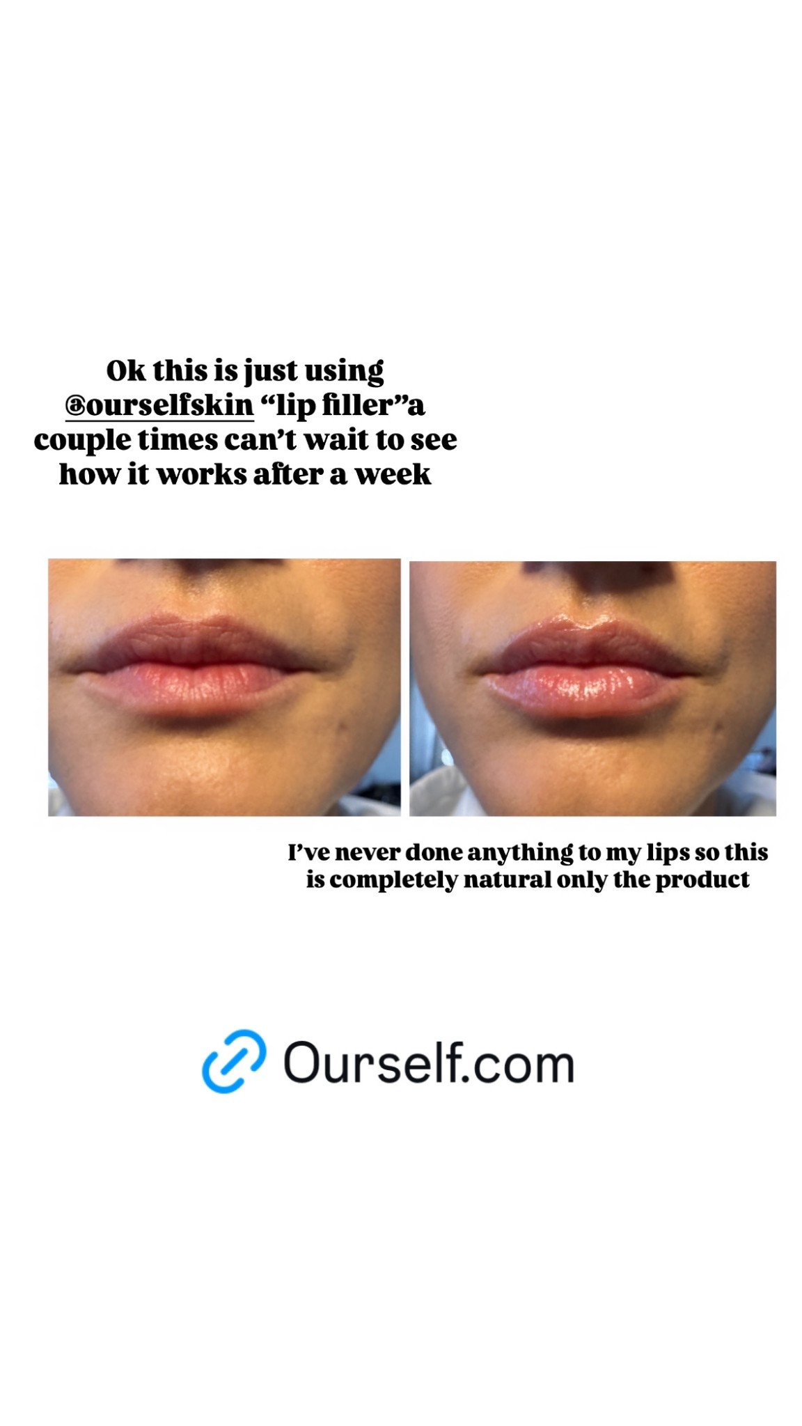 Tried Ourself Lip filler topically applied and works like a charm after only a couple of uses! 