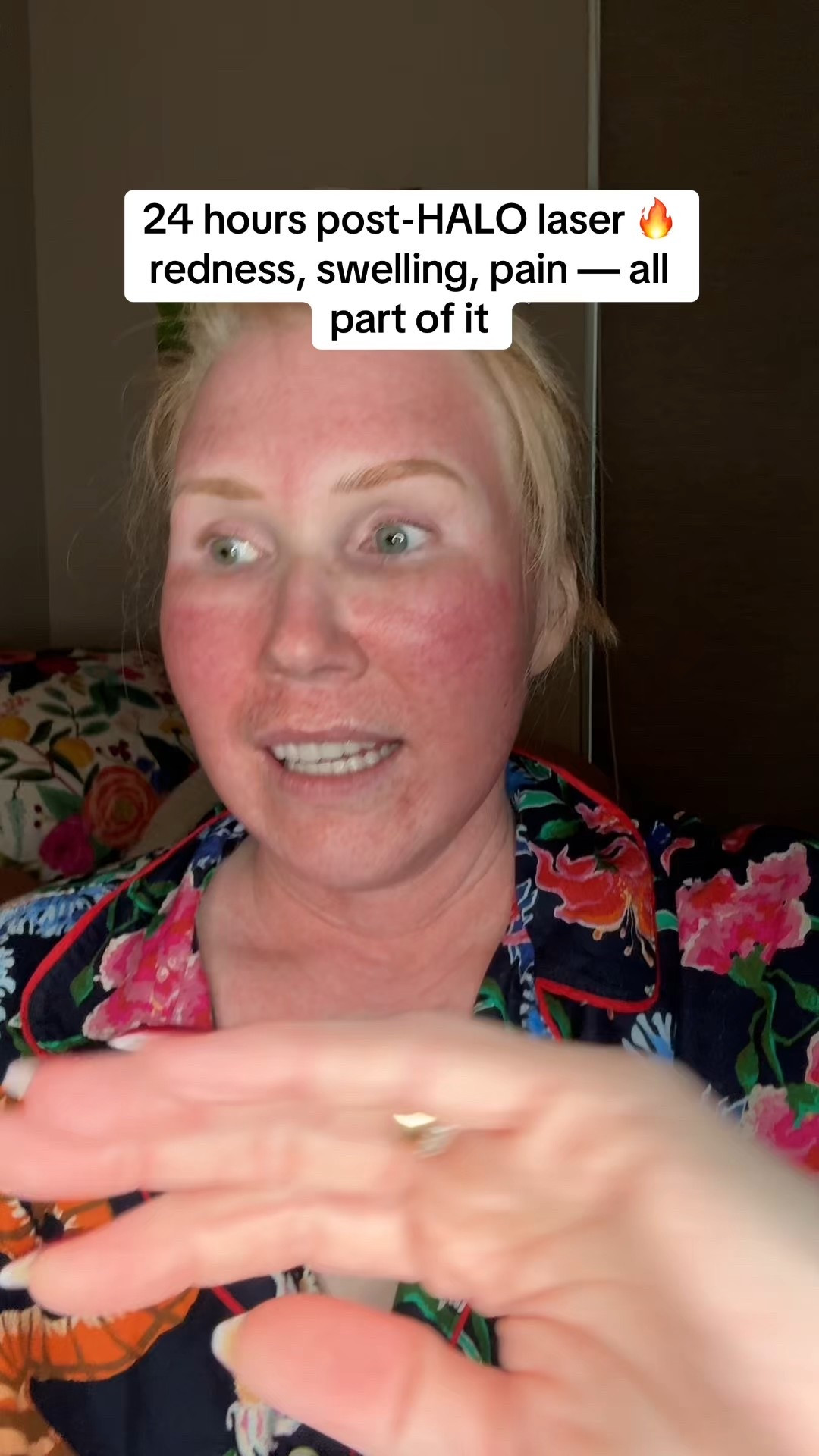 These are the products I used to soothe my face, neck and chest after my halo laser treatment! #lasertreatment #barrierrepair #halaser #skinprocedures

#LTKBeauty