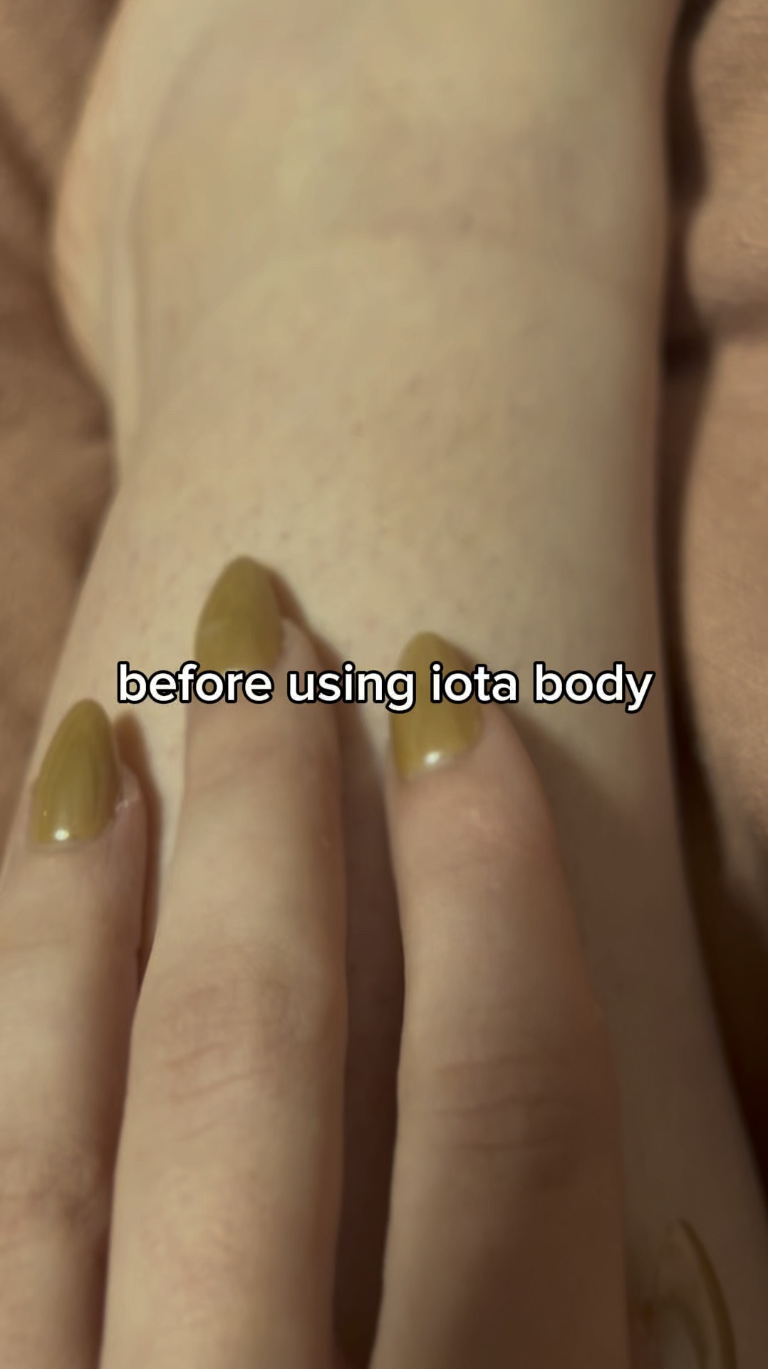 #ad | After 30 days with iota body, the results speak for themselves! 🌱✨ My skin went from red, patchy, and uneven to smoother, brighter, and less irritated. Body care that truly works! 

#TheBanannieDiaries #iotabody #bodycarerevolution #skincareresults #healthyskin #cleanbeauty #ltkbeauty #smoothskin #supergreensset #bodycareelevated #cleanbeauty #healthyskin #skincareessentials #ltkbeauty #bodycareroutine #glowingskin #ltkgiftguide #ltkbeauty #ltkholiday

These statements have not been evaluated by the Food and Drug Administration. This product is not intended to diagnose, treat cure, or prevent any disease.

#LTKGiftGuide #LTKWatchNow #LTKSaleAlert