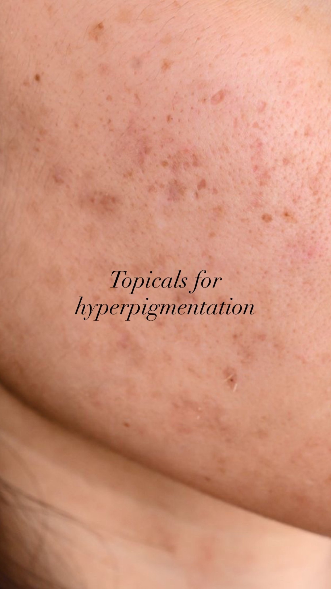 Best daily topicals for hyperpigmentation! Scars, acne scars, melasma treatments 

#LTKmorningroutine #LTKBeauty #LTKselfcare