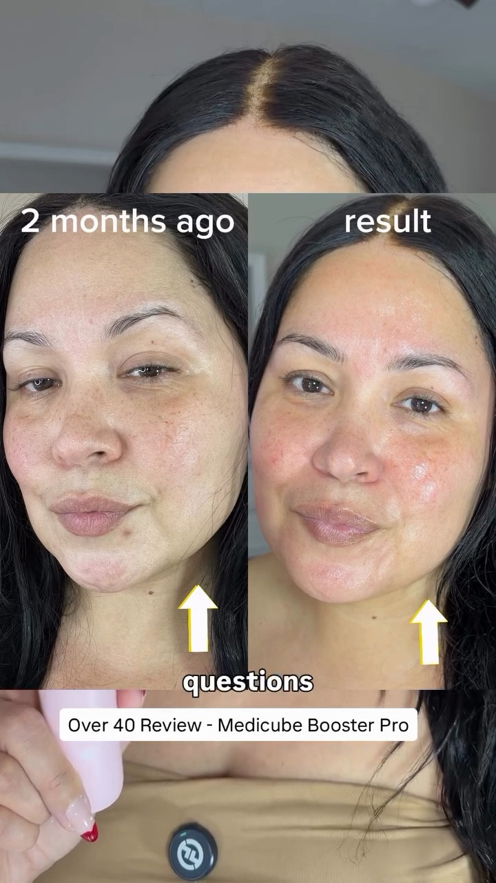 Yes, its worth the investment! @medicube_global_official Booster Pro makes a visible difference in skin smoothness, firmness and glow. My lines and wrinkles are more plump and my skin looks more rejuvenated. This is a devise I will always use!
#medicube #medicubedevice #boosterpro #kbeauty #skincaredevice 
Medicube Partner

#LTKBeauty #LTKOver40 #LTKselfcare