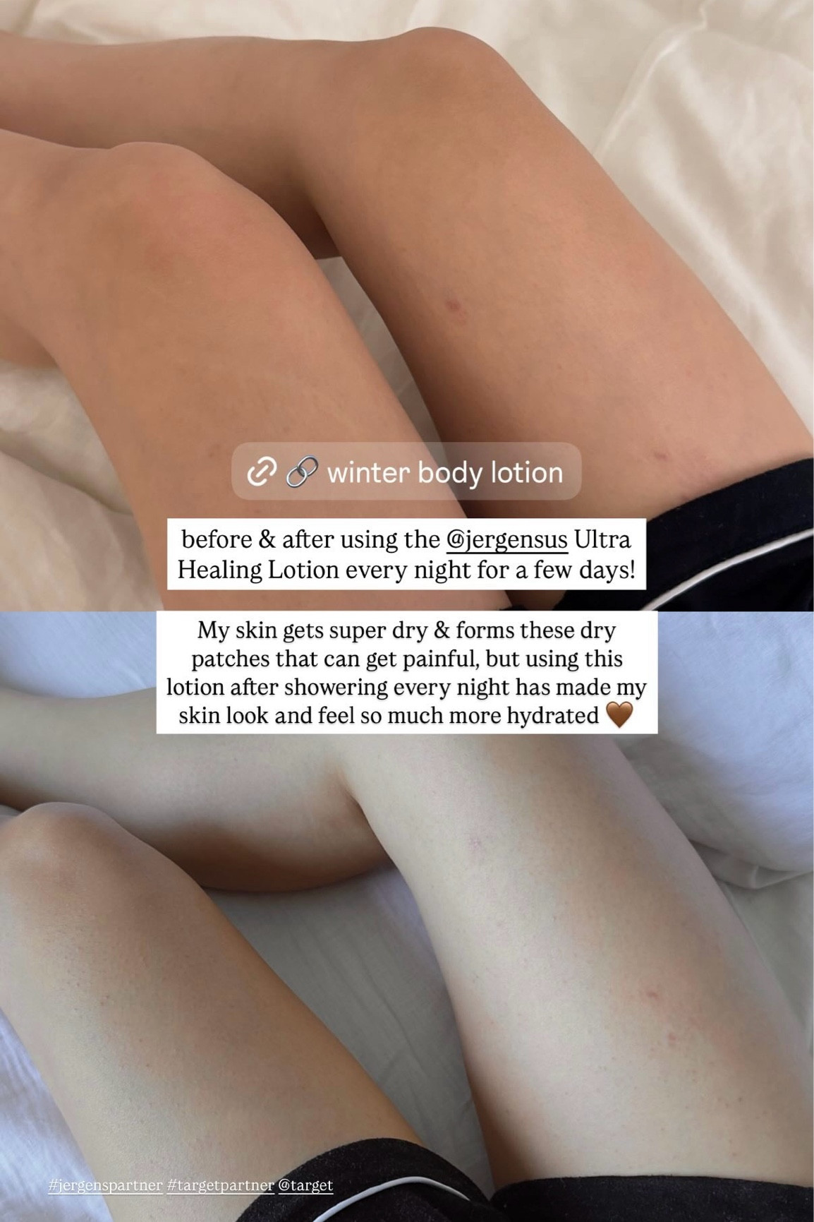 #ad before and after of using the Jergens Ultra Healing Body Lotion for a week — my dry patches are so much better now! @jergensus @target

#LTKFindsUnder50 #LTKSaleAlert #LTKSeasonal