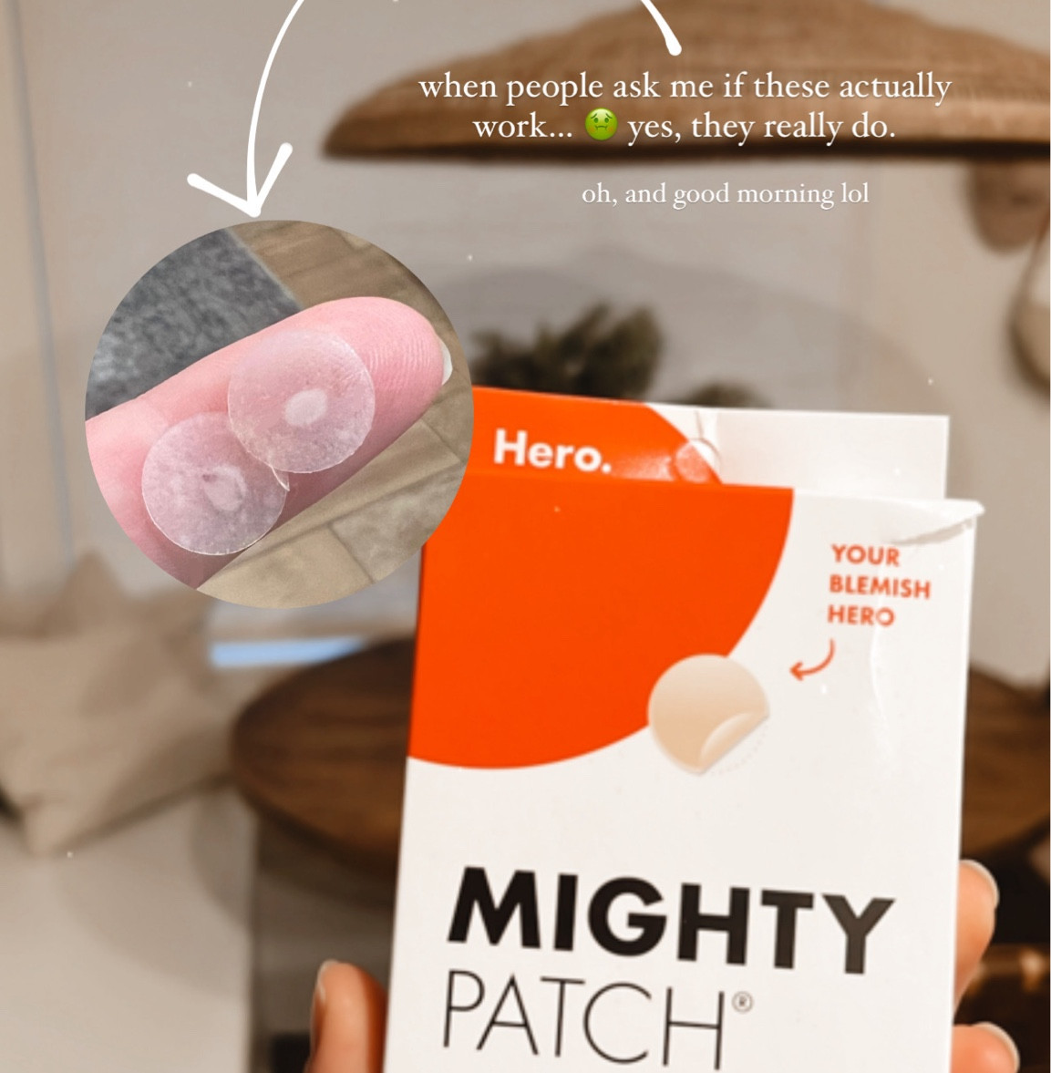 The best remedy for pimples! Works like a charm, every time 👌🏼

#LTKitbag #LTKsalealert #LTKbeauty