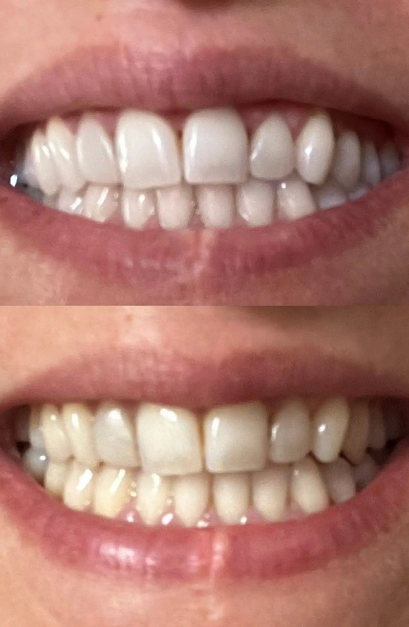 SNOW Advanced Teeth Whitening LED Toothbrush | Nordstrom | Nordstrom