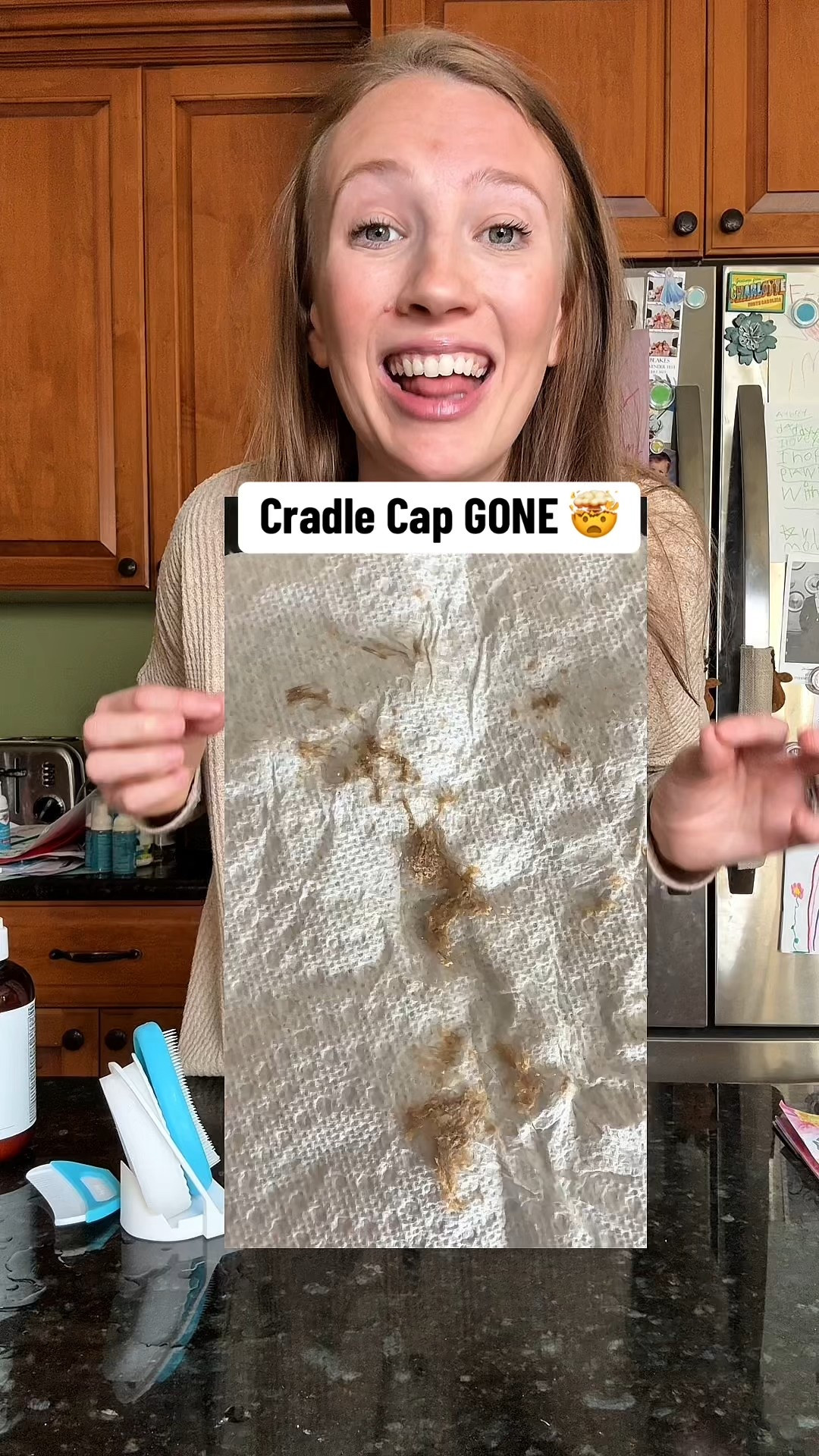 How to get rid of cradle cap. Newborn tips | New mom Tips | Baby Products

#LTKmomlife #LTKBaby