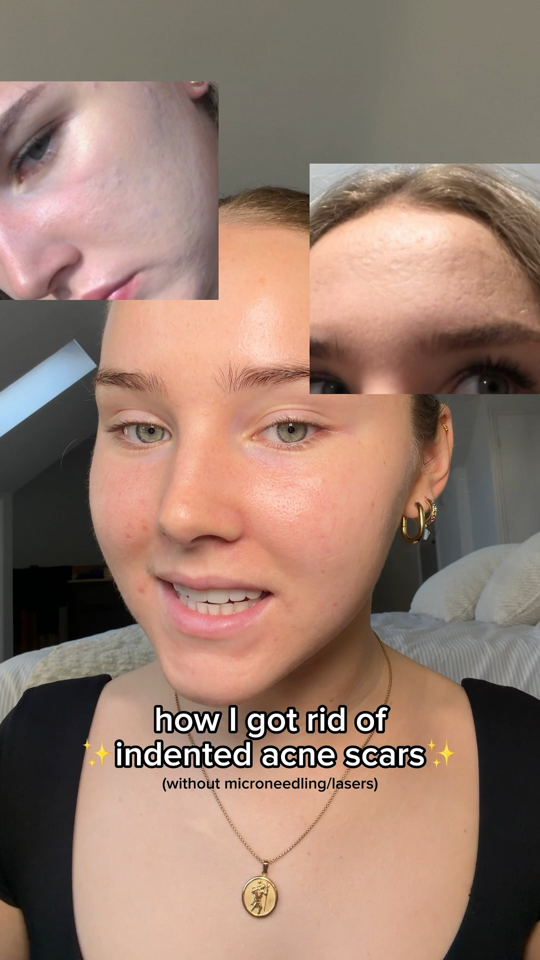 acne scarring products!
code LIFEWITHMILS for Dr Sam’s & code LIFEWITHMILS2 for YesStyle💕