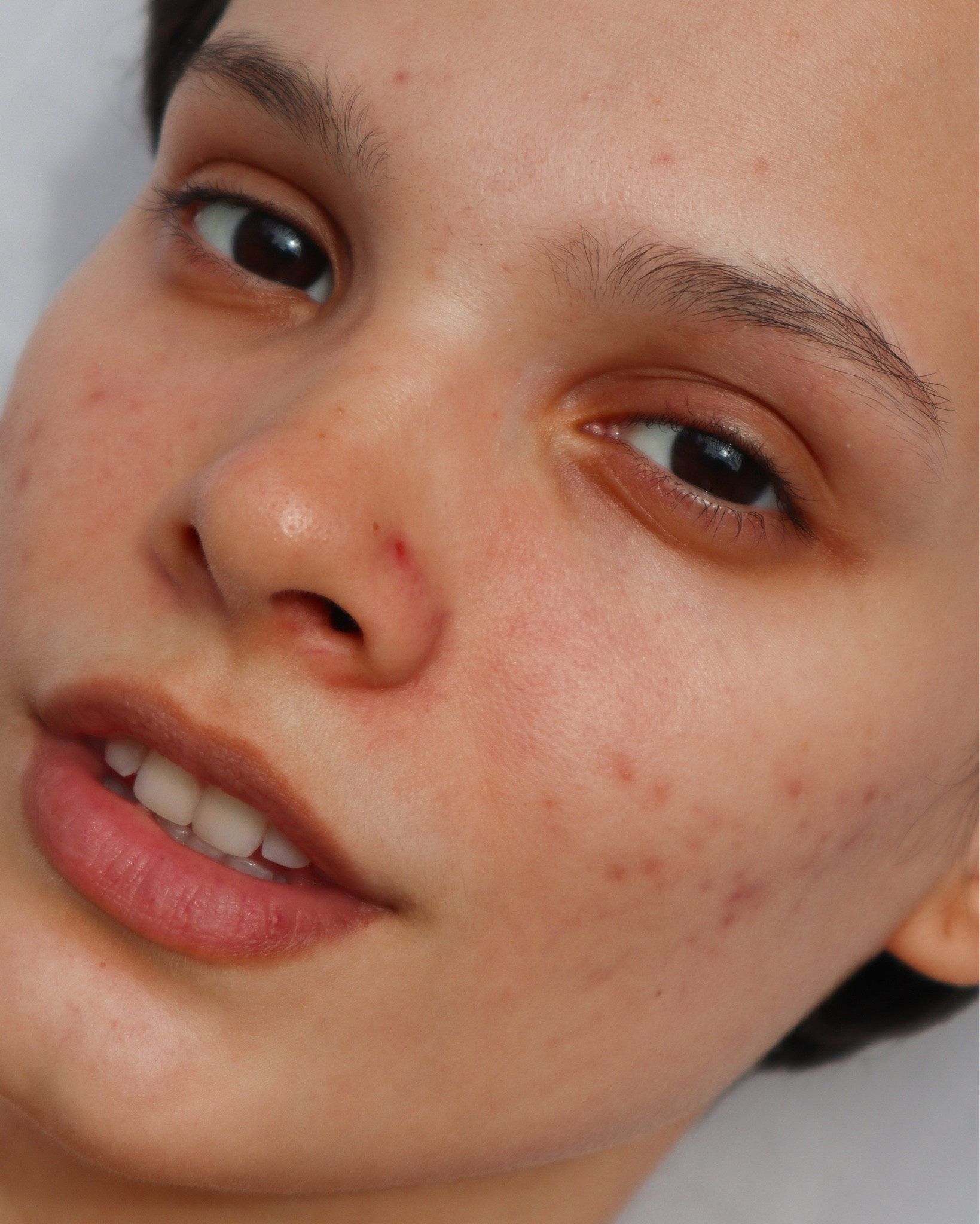 skincare para pele acneica com produtos Sallve

#LTKbeauty #LTKbrasil