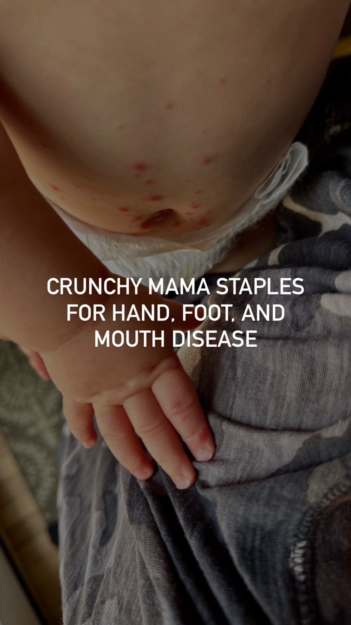 As a crunchy mama, these are all the things I keep on hand to help my kids find relief & support their immune system through HFMD ✋🏻🦶🏻👄

See more in my blog post at meeklyloving.com!

#LTKBaby #LTKmomlife #LTKKids