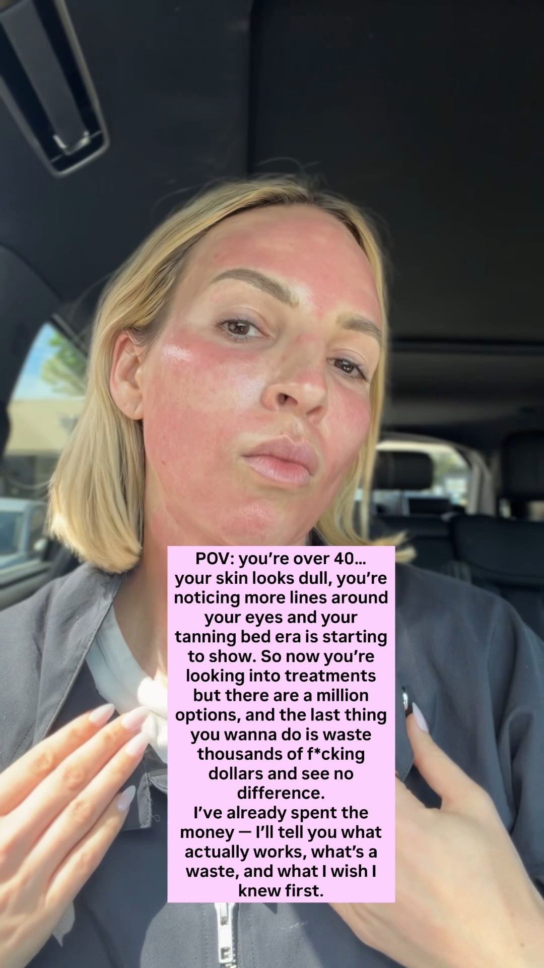 Everything I do for my skin, start to finish:

•Botox for movement, every 3-4 months
•Sculptra for long-term collagen + structure (about 4 vials a year)
•Fractionated Coolpeel 2x a yr for tone, sun damage, and texture
•Microneedling with PDGF at least 4x a yr for overall skin quality
•Microneedling at home every other month (As long as I give it four weeks from my professional micro needling treatment)
•Skin stamping 1x a week to make sure my growth factors are fully penetrate ￼
•Exfoliate 2x a week, one with a physical and one with a chemical ￼
•Skin flooding morning and night ￼￼
•Tretinoin at night as often as skin can tolerate 
•Vitamin C and niacinamide in the morning
•Peptides every morning and night (copper only at night) to support collagen
•Barrier repair + deep hydration (overnight collagen masks)
•Red light at least 4x a week (I don’t use it the nights I use tretinoin)￼
•SPF every single day
•Dermablade 1x week ￼




#LTKOver40 #LTKBeauty #LTKselfcare