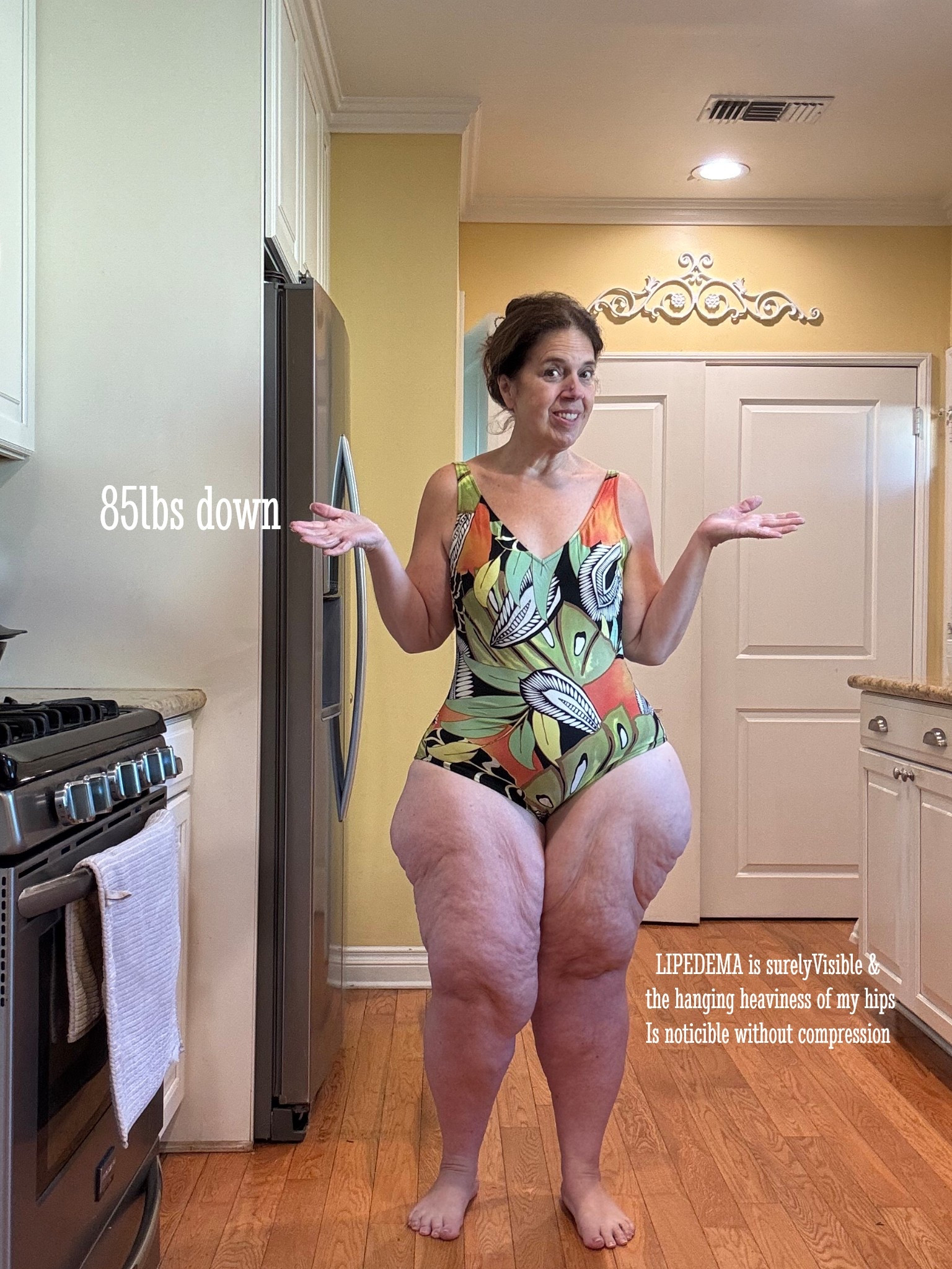 85lbs down since end of 2023

Lots of mobility restored, regain that had krept in since my LIPEDEMA diagnosis in 2017 gone, inflammation dramatically reduced yet still holding on mainly in my hips, all AFIB meds dropped, sleep apnea diminished, officially 210lbs down since my highest 22 yrs ago pre Rouen-Y gastric bypass.

GLP1 has been transformative in how my body functions and the relief it provides to my entire system.

The journey continues and I am looking forward to putting some new systems into place to ensure continued improvements.

Are you joining me in community for your health journey? Comment COMMUNITY for details.

#LTKActive #LTKOver40 #LTKselfcare